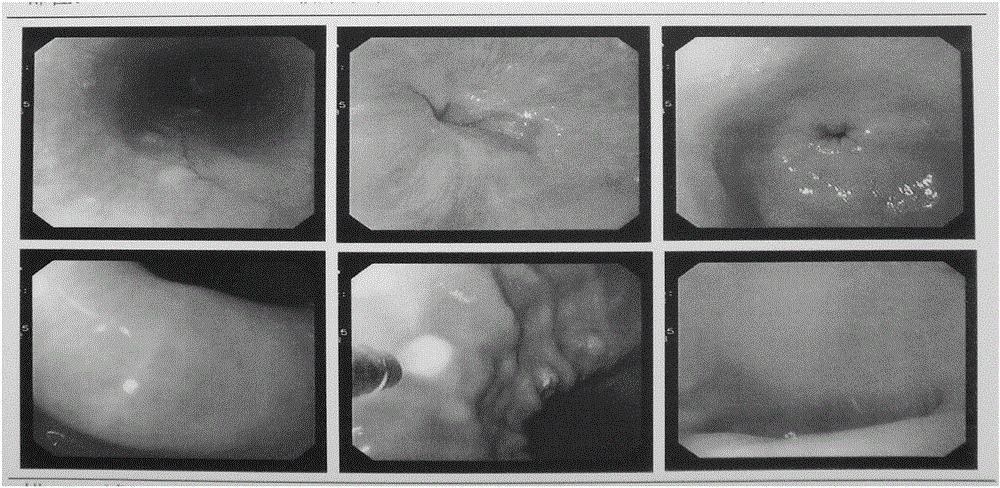 Immune cell preparation for treating chronic atrophic gastritis and gastric precancerous lesions and preparation method and application of immune cell preparation