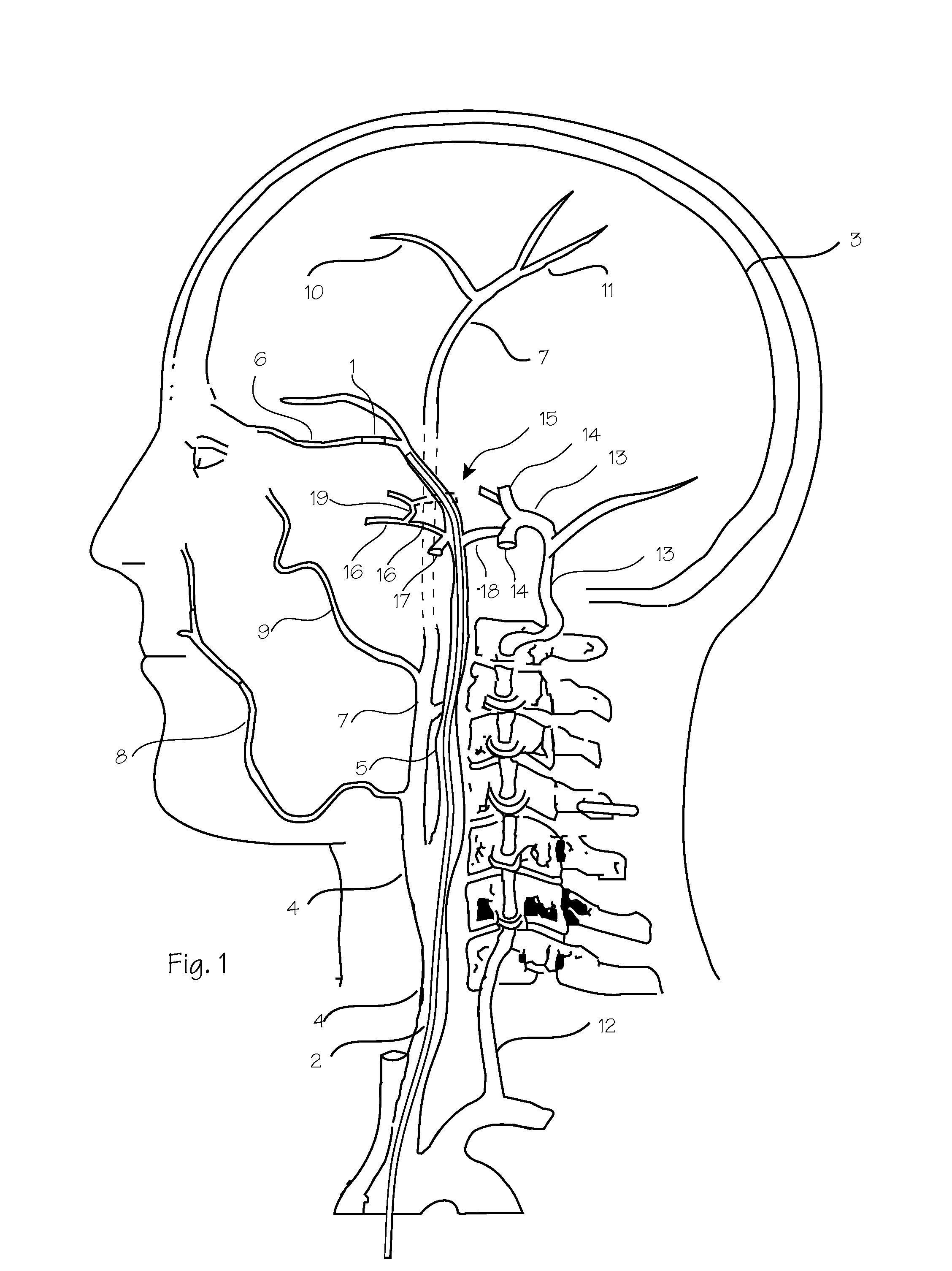 Intracranial Stent and Method of Use