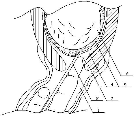 Visible artificial fetal membrane breaking device and use method thereof