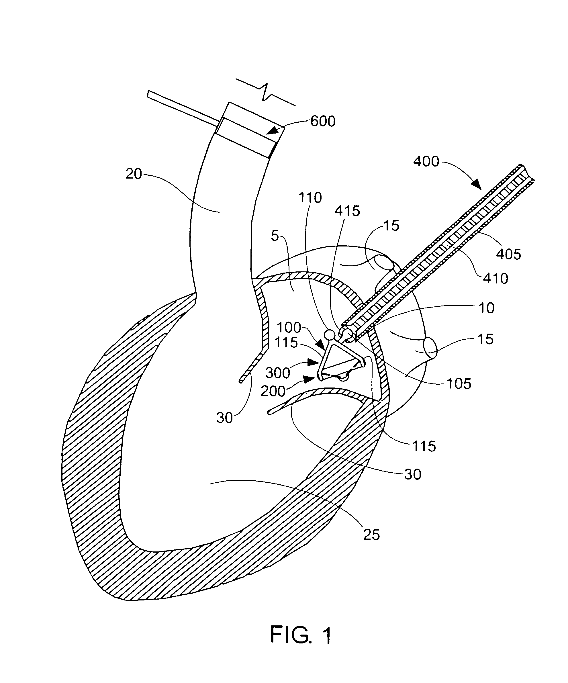 Method and apparatus for resecting and replacing an aortic valve