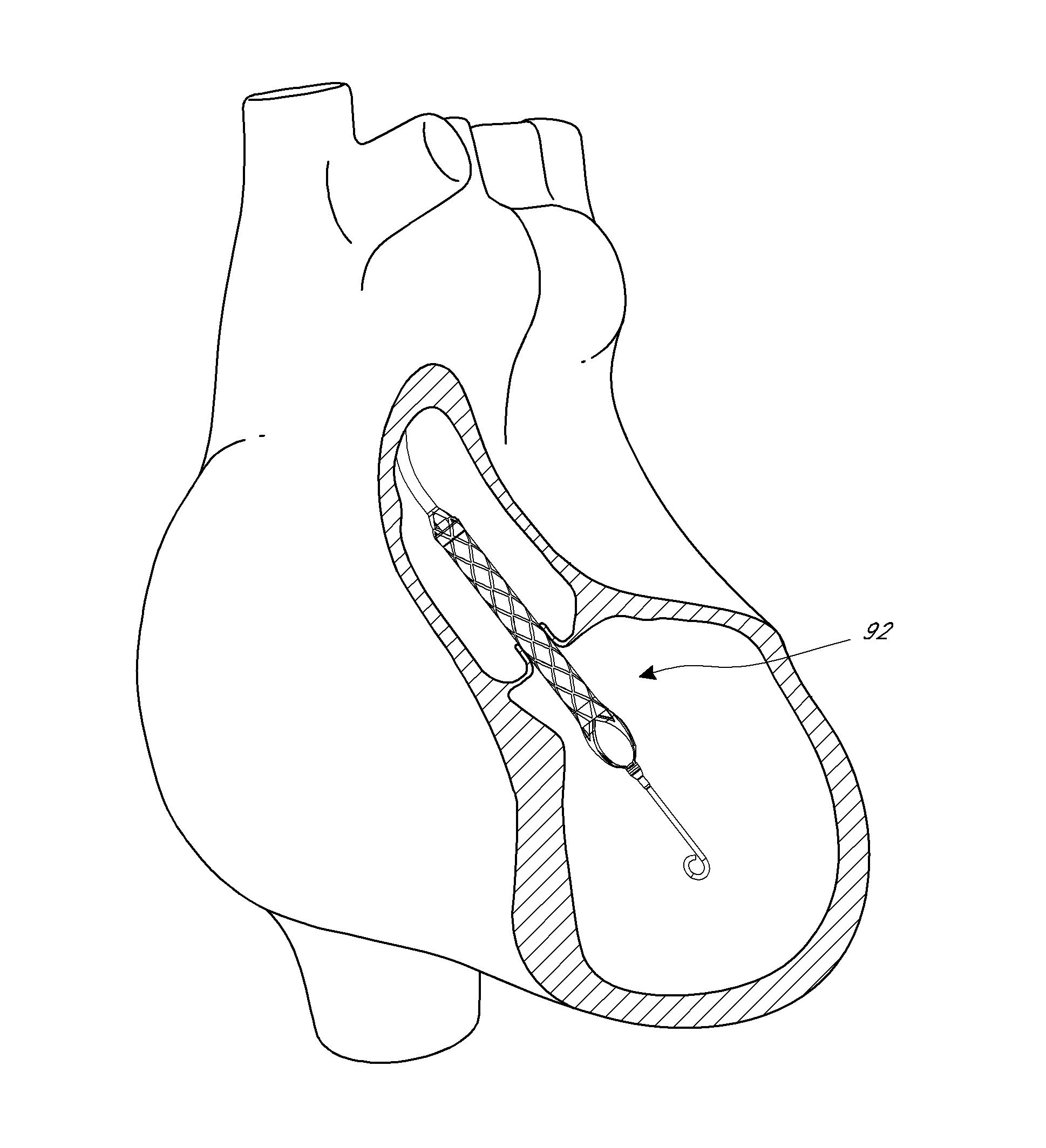 Impeller for catheter pump