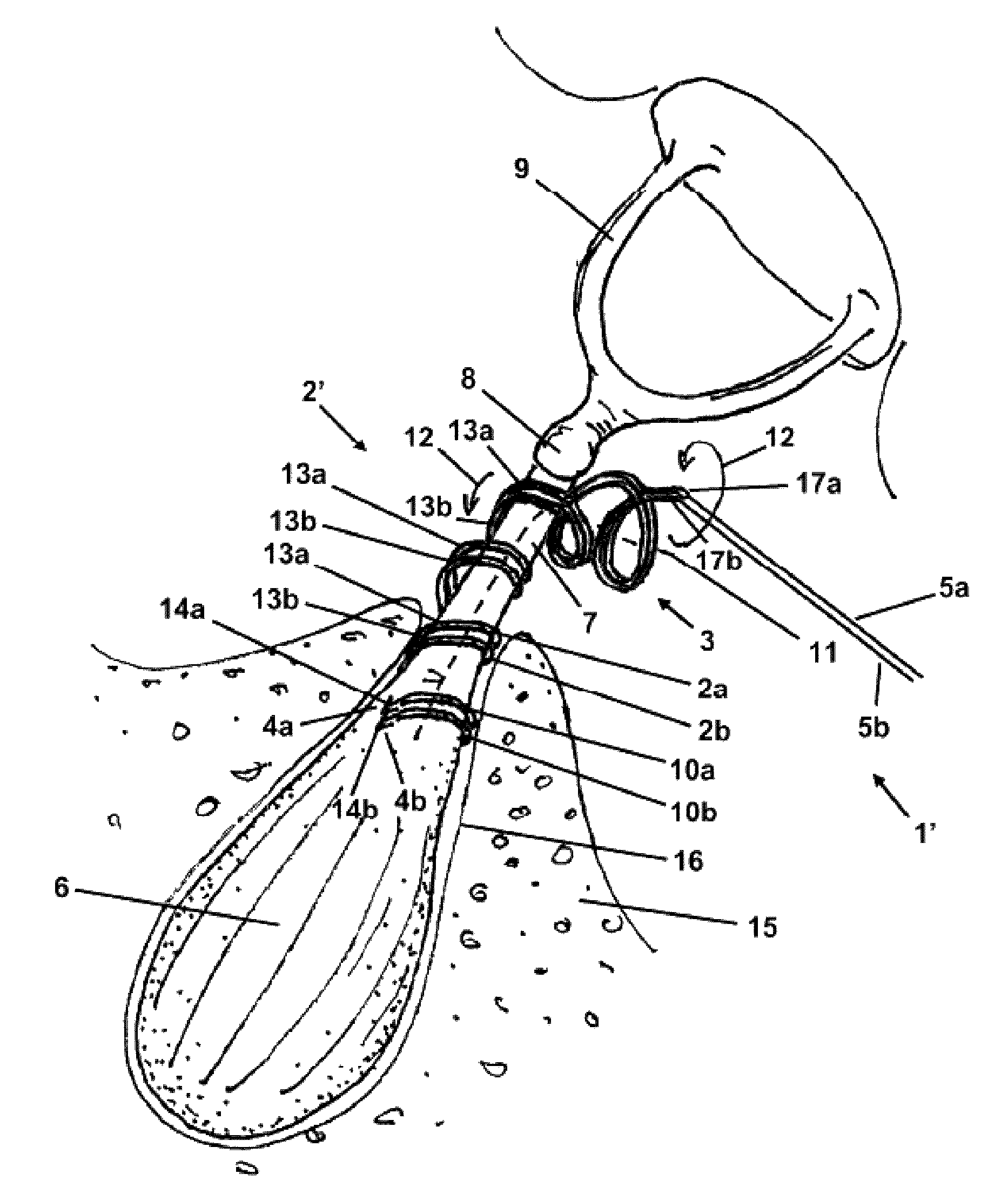 Stapedius muscle electrode