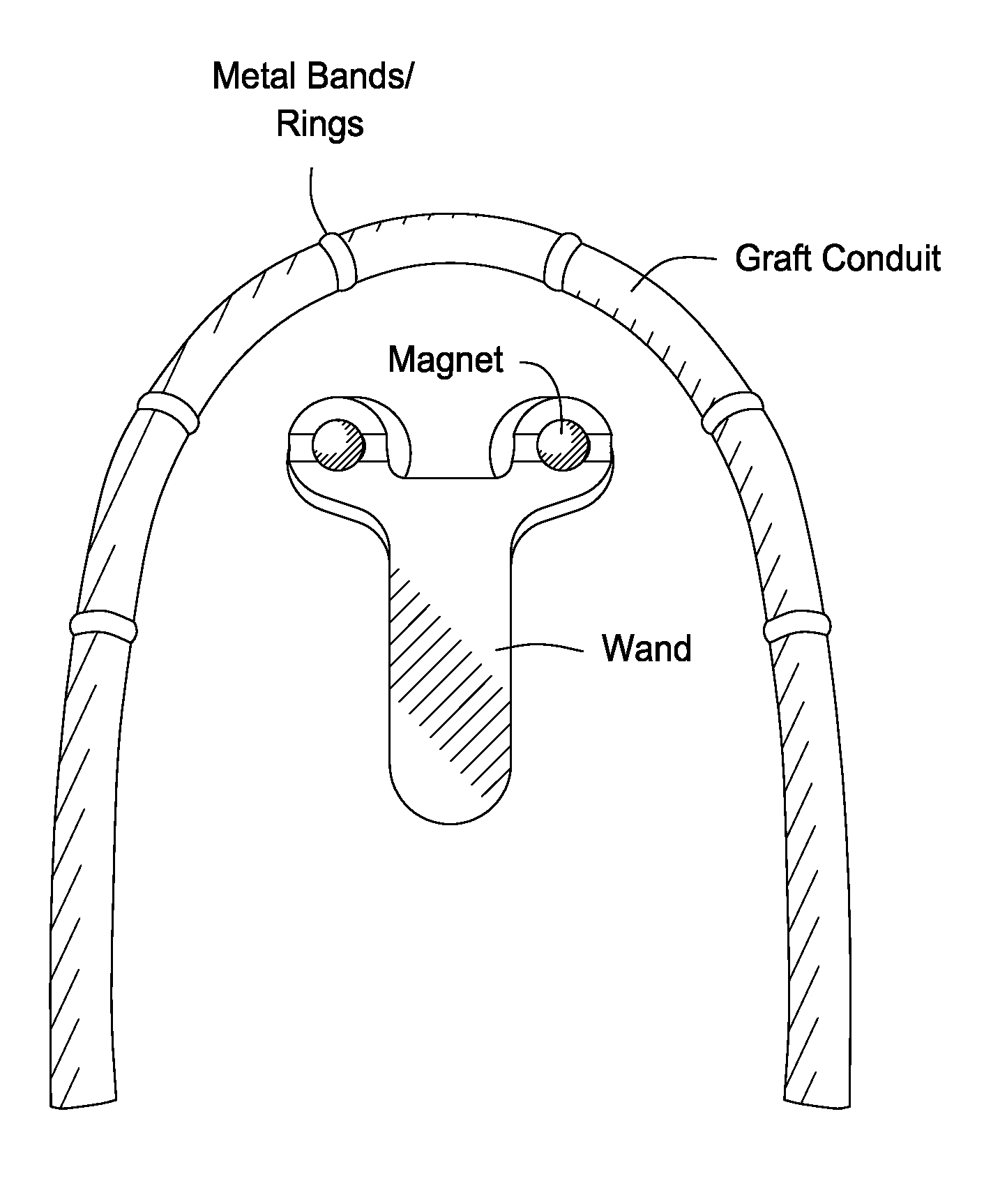 Hemodialysis grafts and methods for localizing and identifying the placement of same