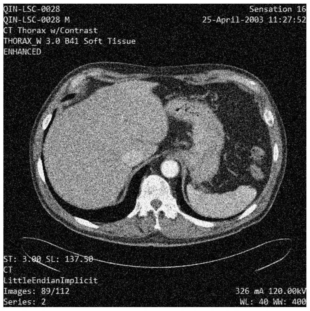 CNN medical CT image denoising method based on noise prior