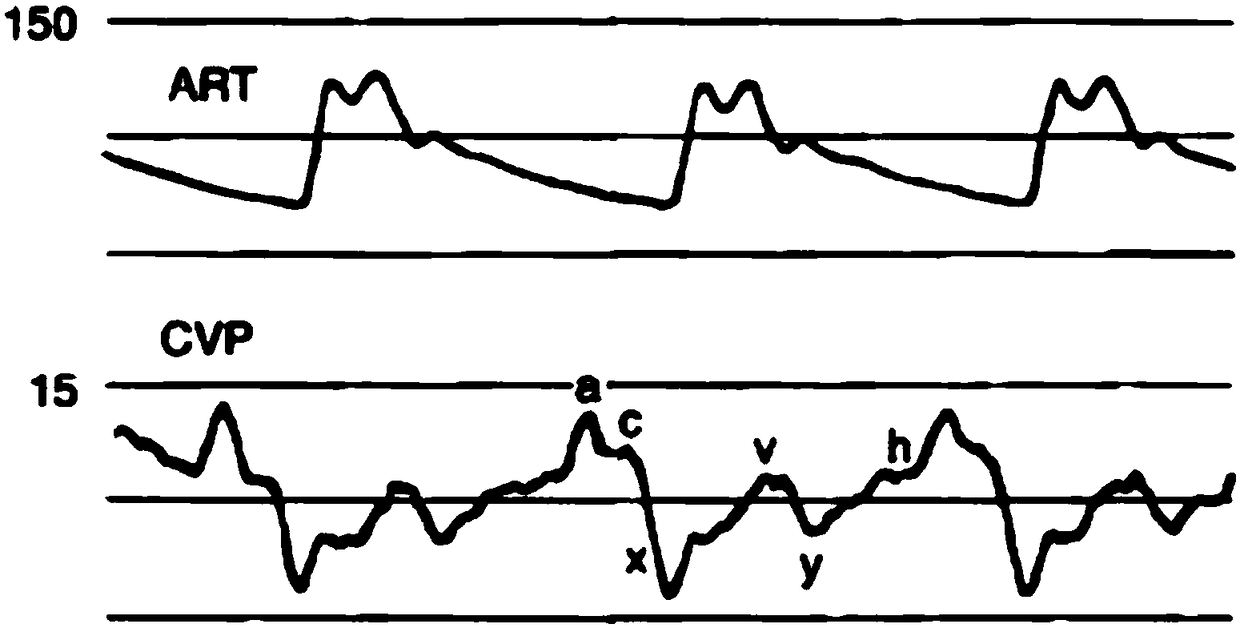 Method and device for judging position of catheter, and monitoring equipment