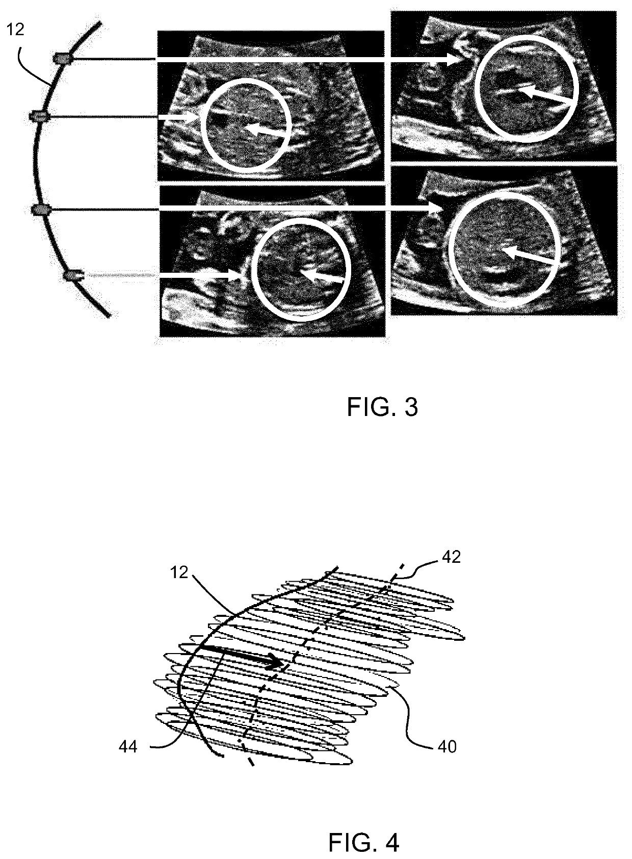 Fetal ultrasound image processing