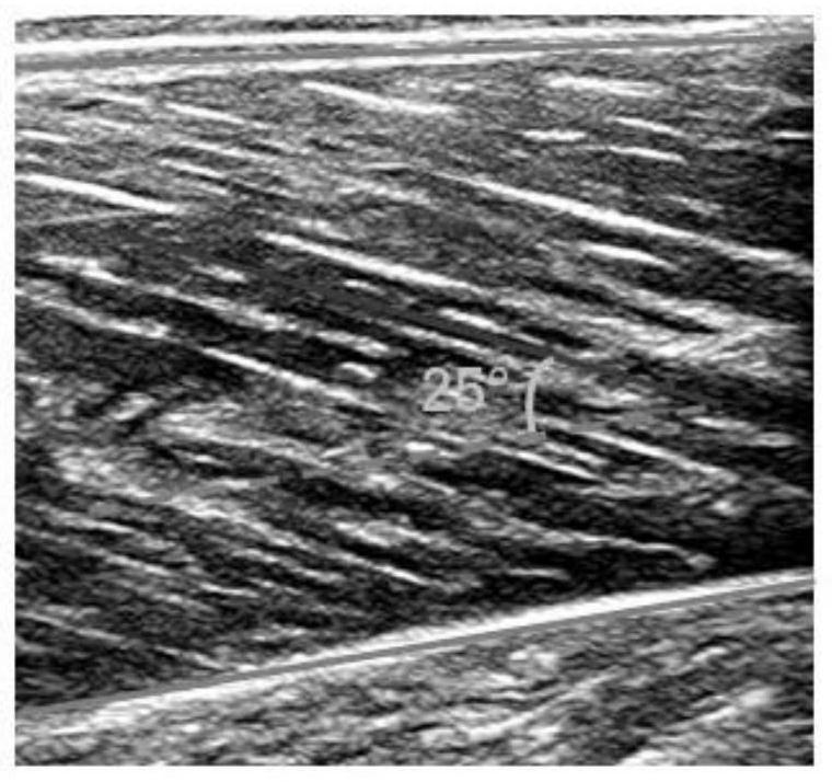 Method for automatically tracking muscle feather angle by combining convolutional neural network and Kalman filtering