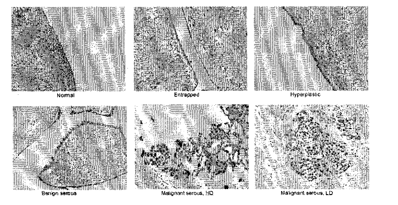 Method for estimating ovarian cancer prognosis by TRPC protein subtype combined detection