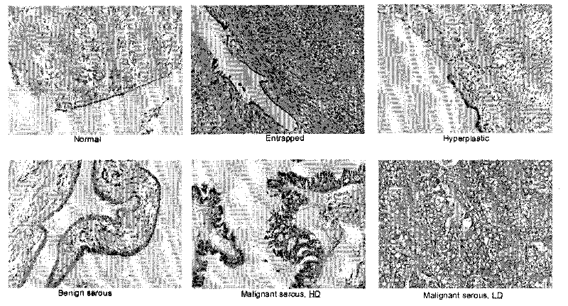 Method for estimating ovarian cancer prognosis by TRPC protein subtype combined detection