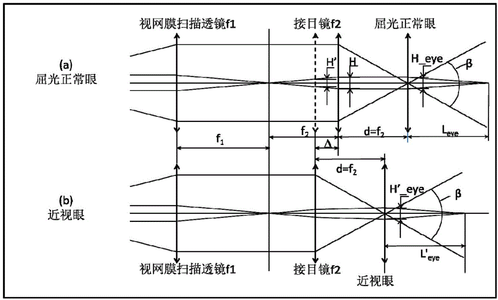 A myopic eye scanning module used for an optical coherence tomography instrument