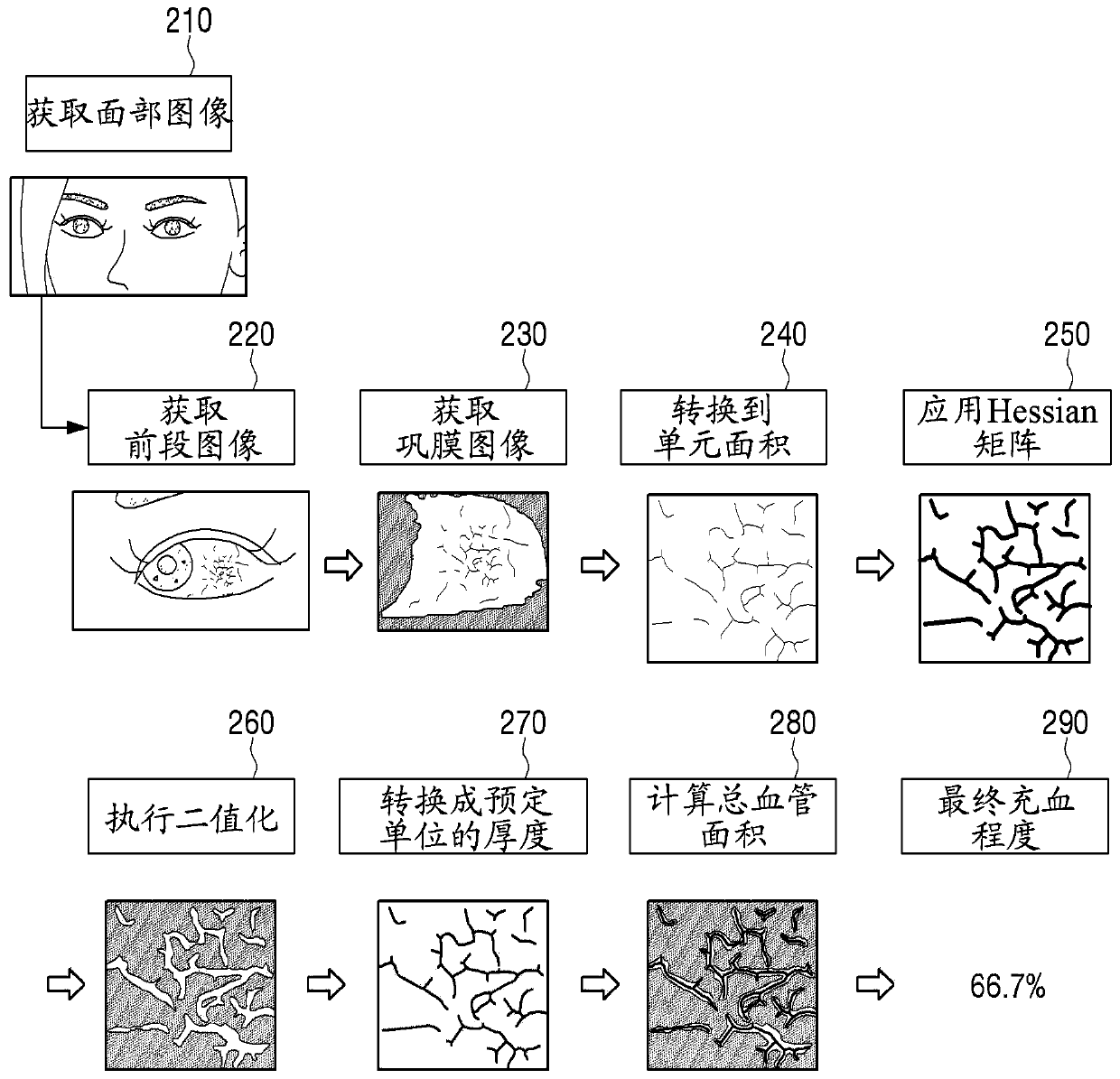 Electronic device and method for determining degree of conjunctival hyperemia by using same