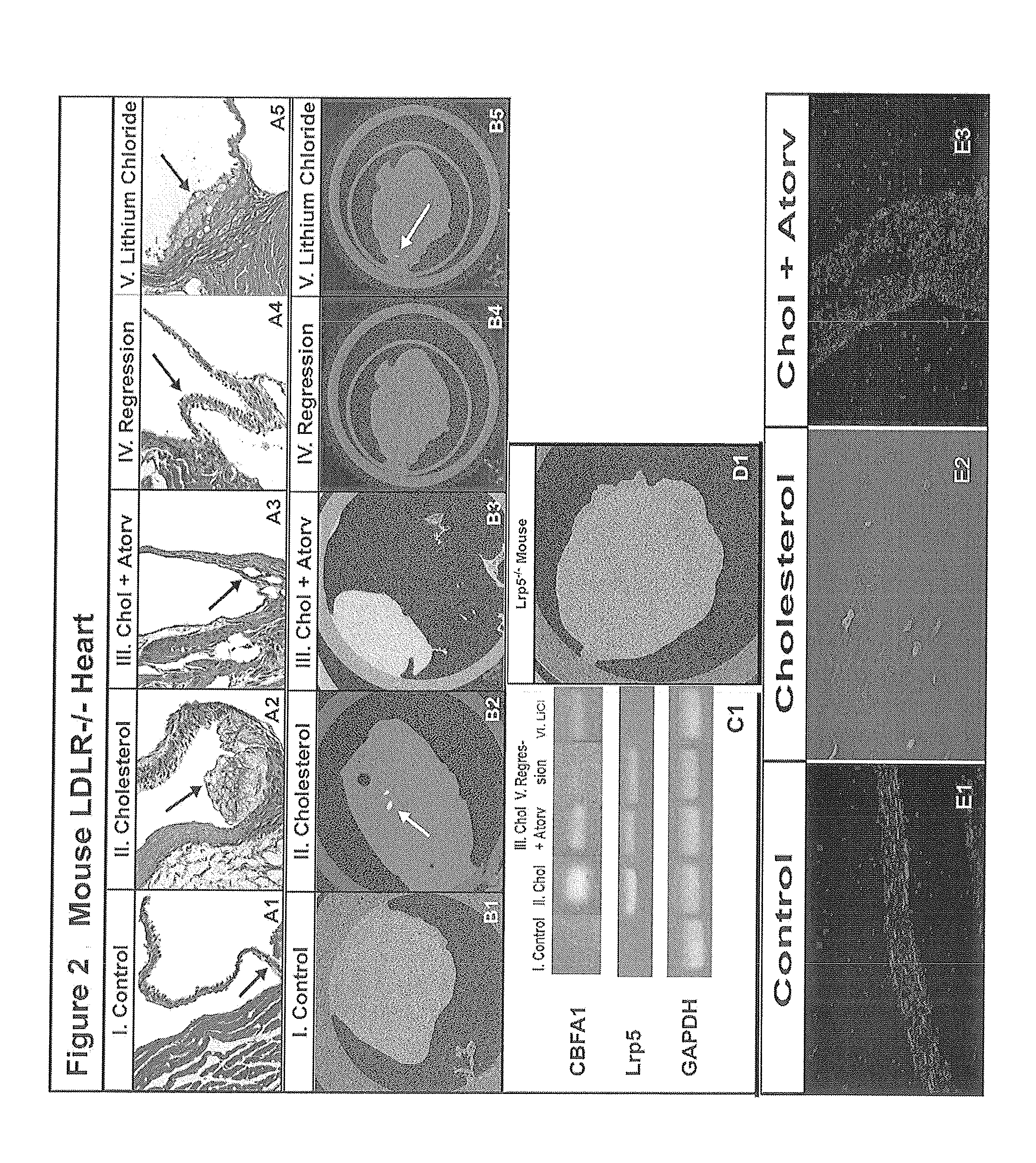 Devices and methods for inhibiting stenosis, obstruction, or calcification of a native heart valve, stented heart valve or bioprosthesis