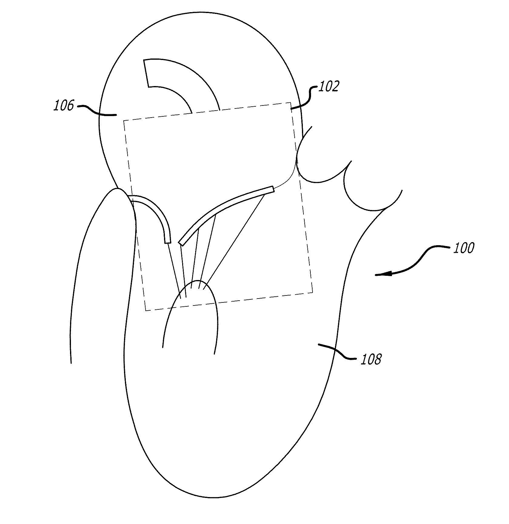 Methods and systems for heart valve therapy