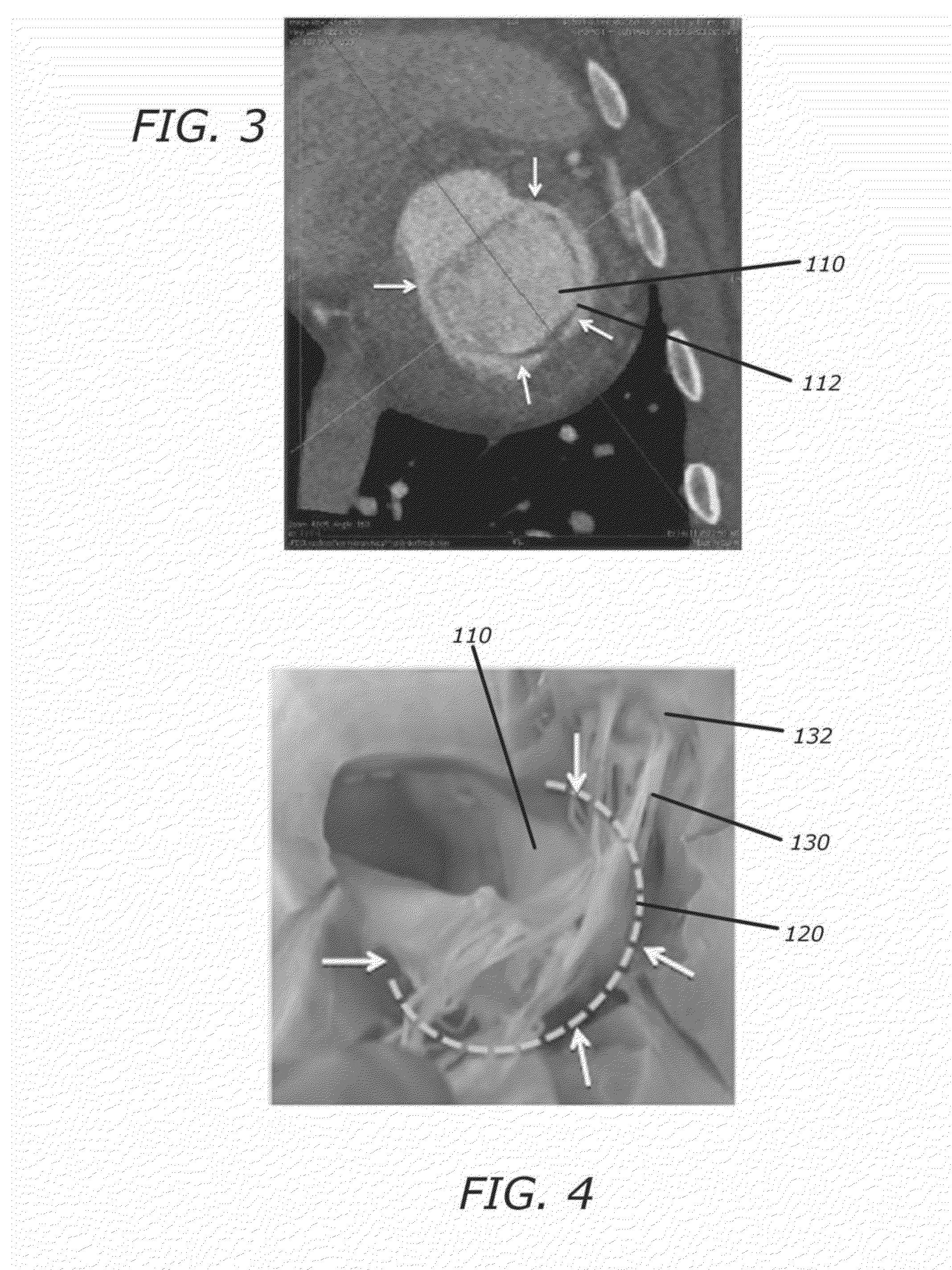 Methods and systems for heart valve therapy