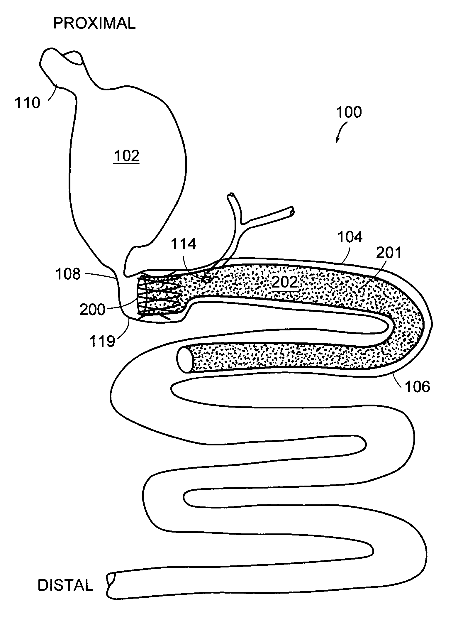 Gastrointestinal anchor compliance