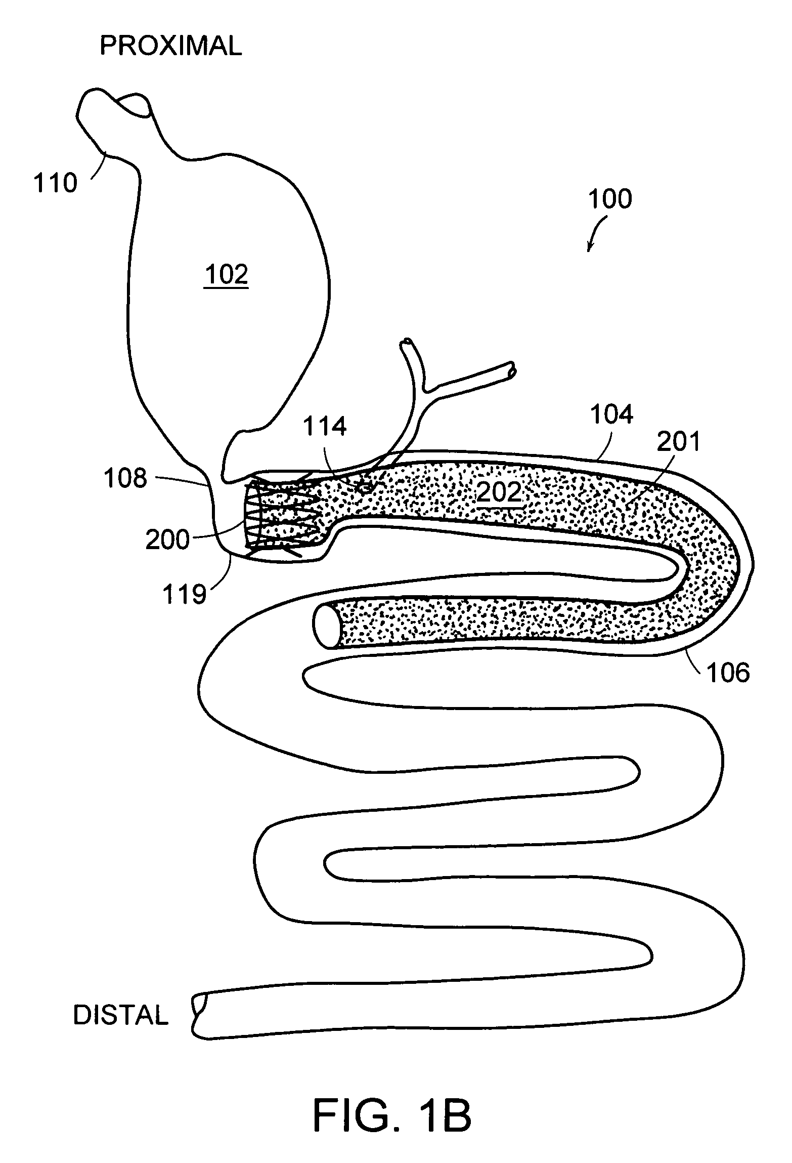 Gastrointestinal anchor compliance