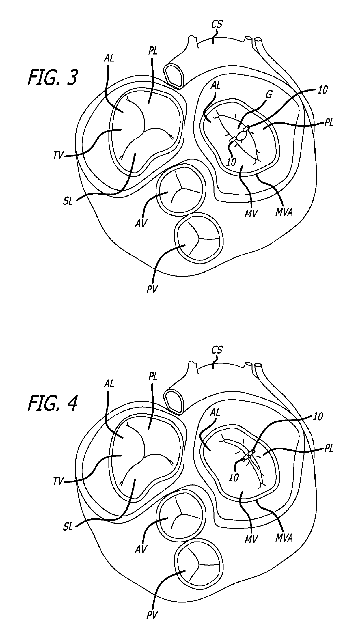 Fixation devices, systems and methods for heart valve leaf repair