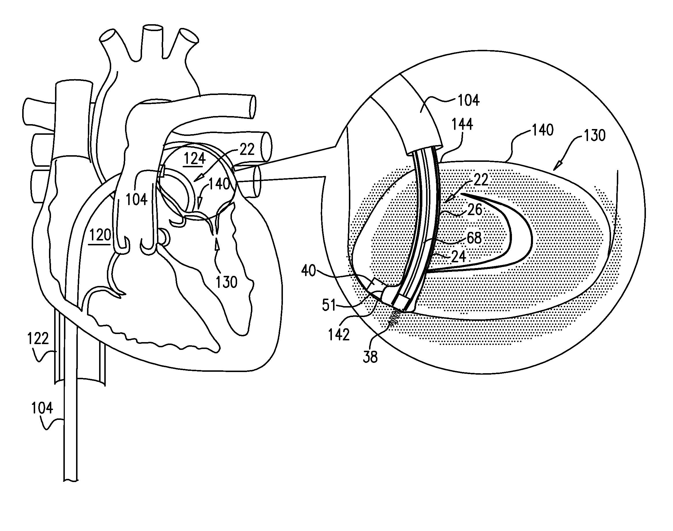 Annuloplasty ring with intra-ring anchoring