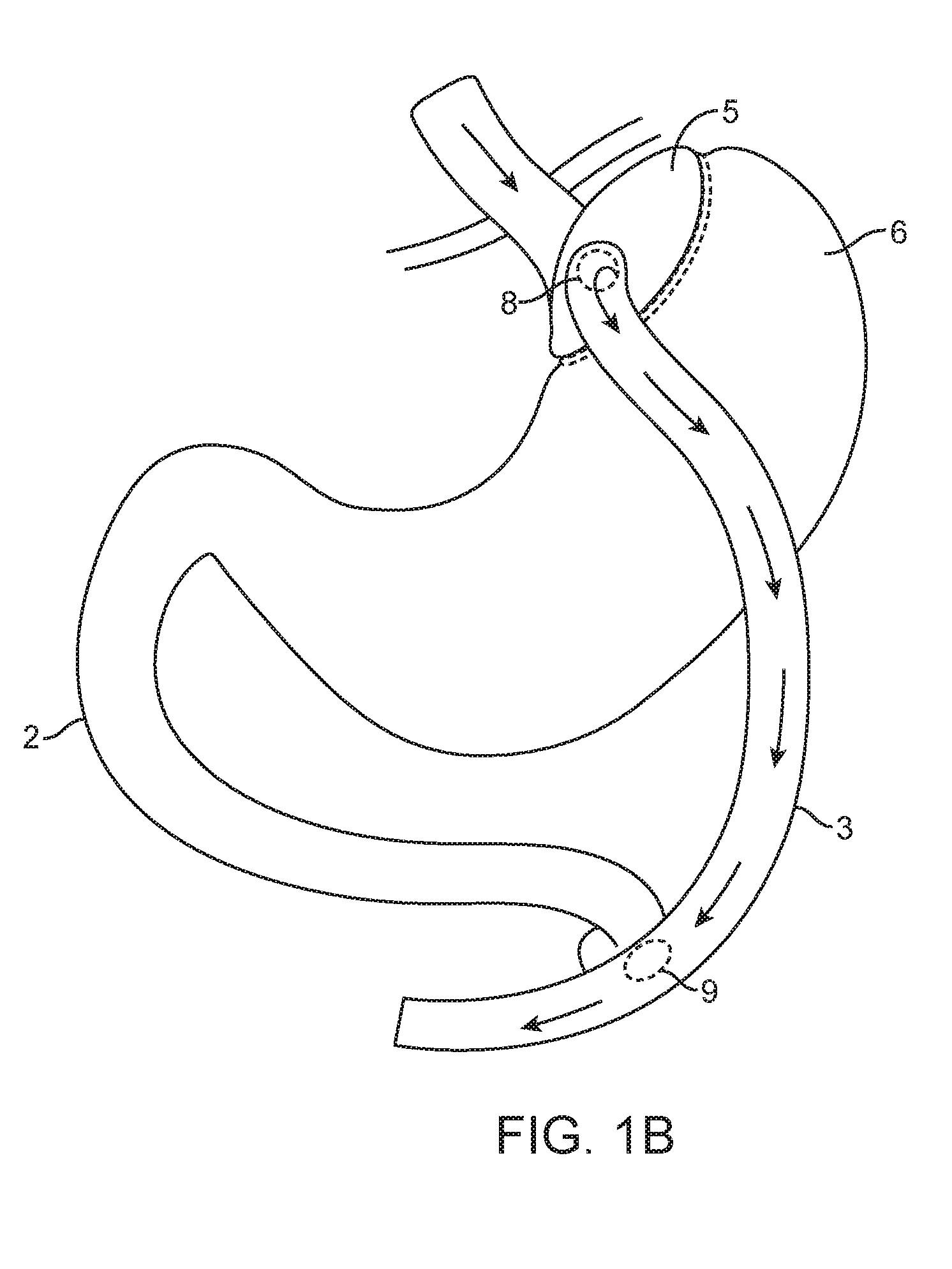 Devices and methods for forming an anastomosis