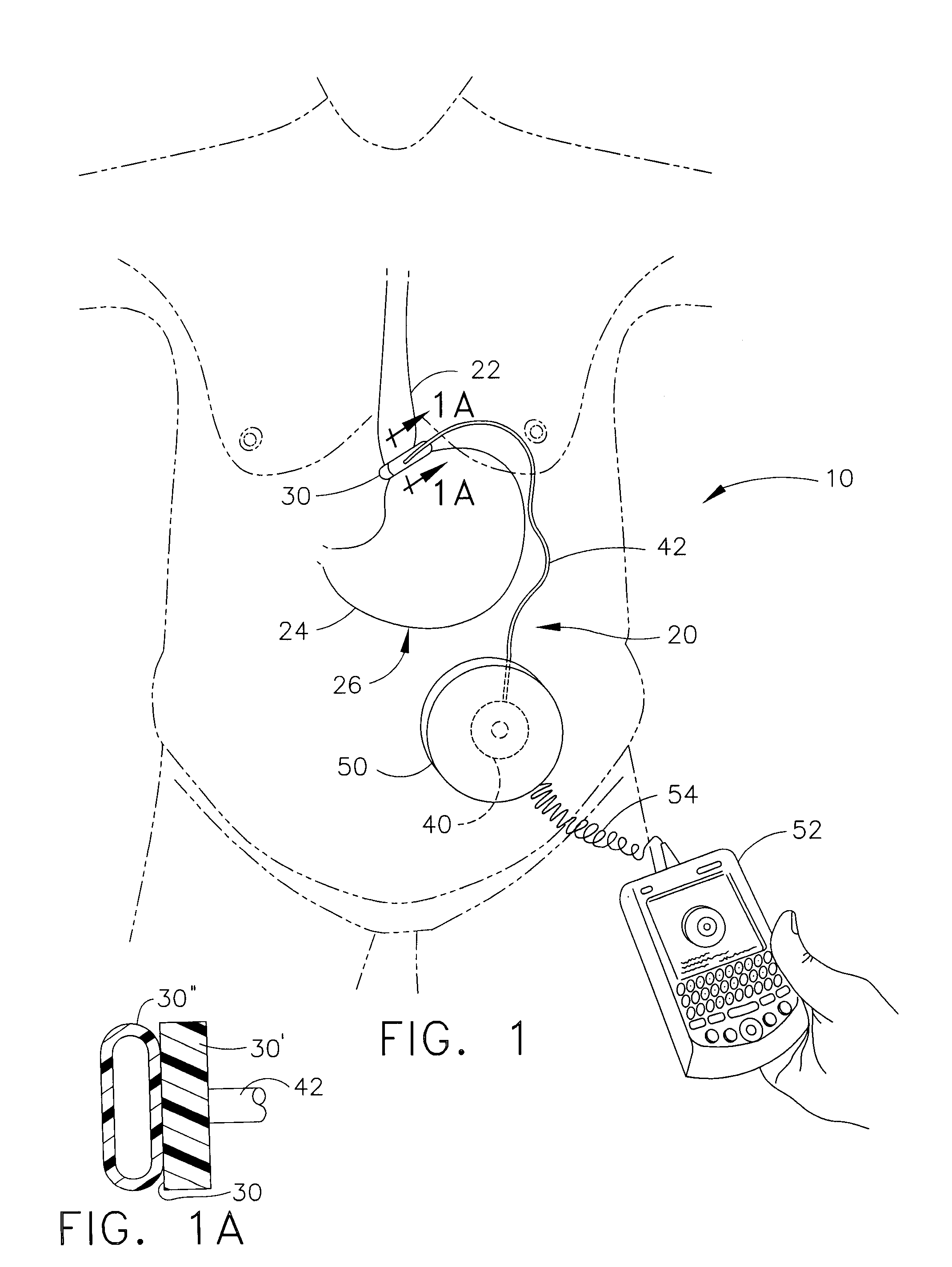 Bi-directional infuser pump with volume braking for hydraulically controlling an adjustable gastric band