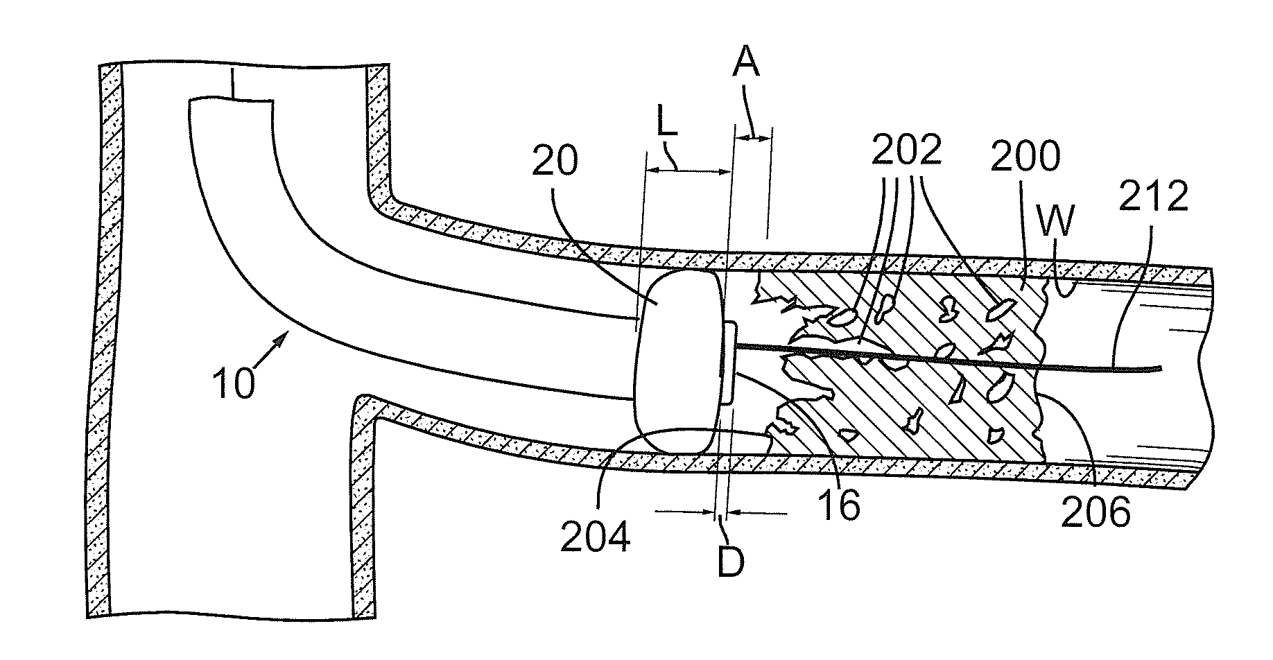 Devices and methods for treating chronic total occlusion