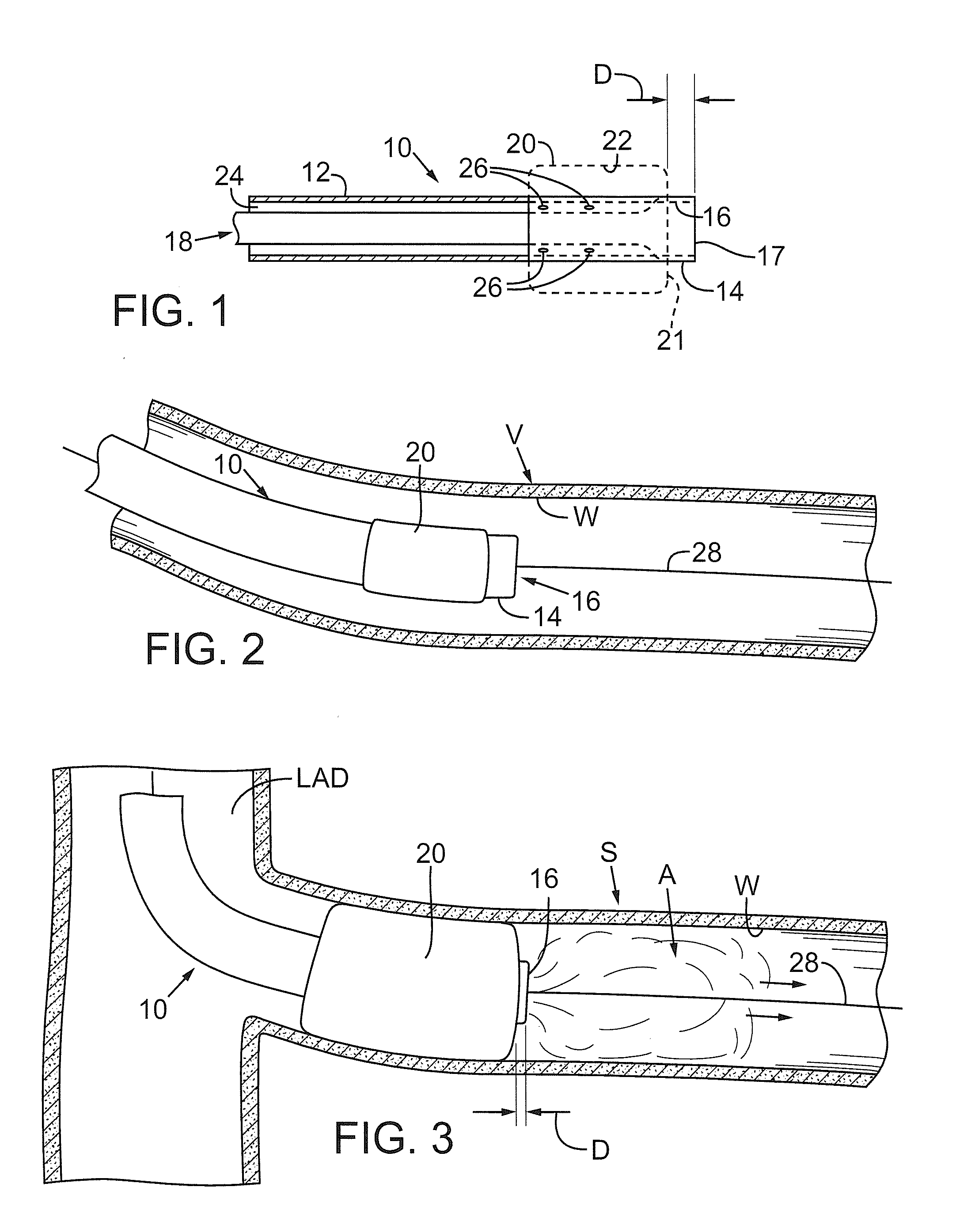 Devices and methods for treating chronic total occlusion