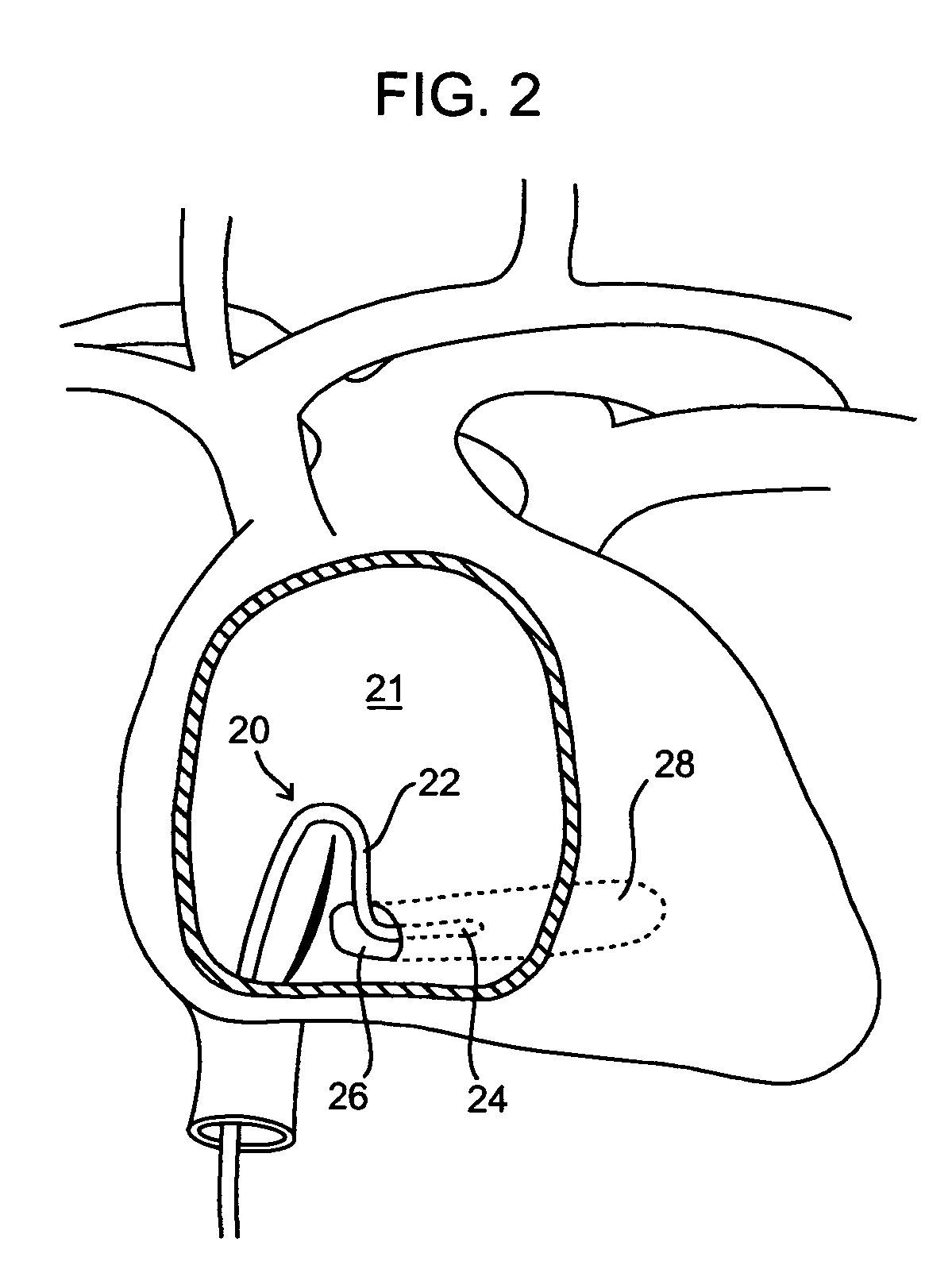 Methods and devices for retrieval of a medical agent from a physiological efferent fluid collection site