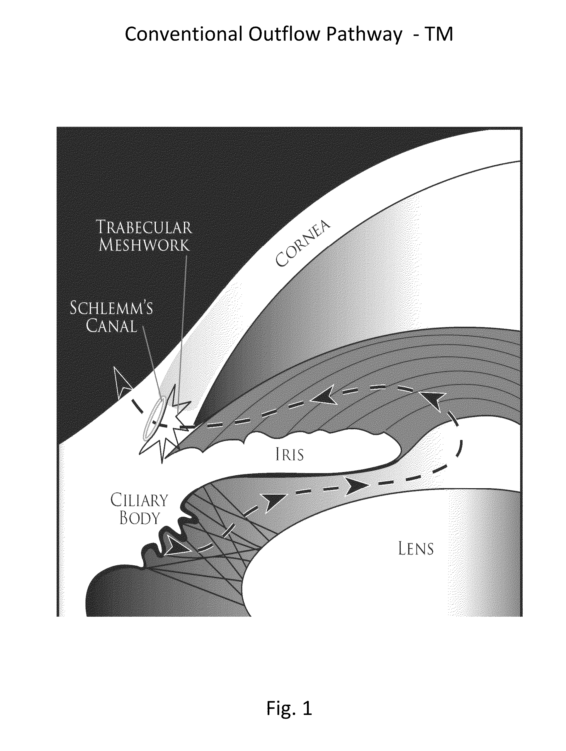 Method for Laser Treatment for Glaucoma