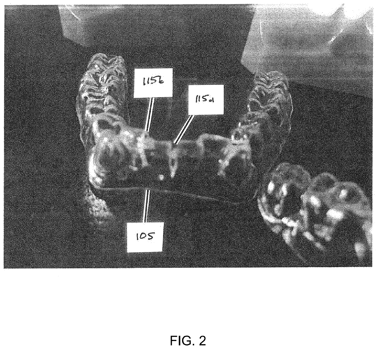 Device and method for interproximal reduction