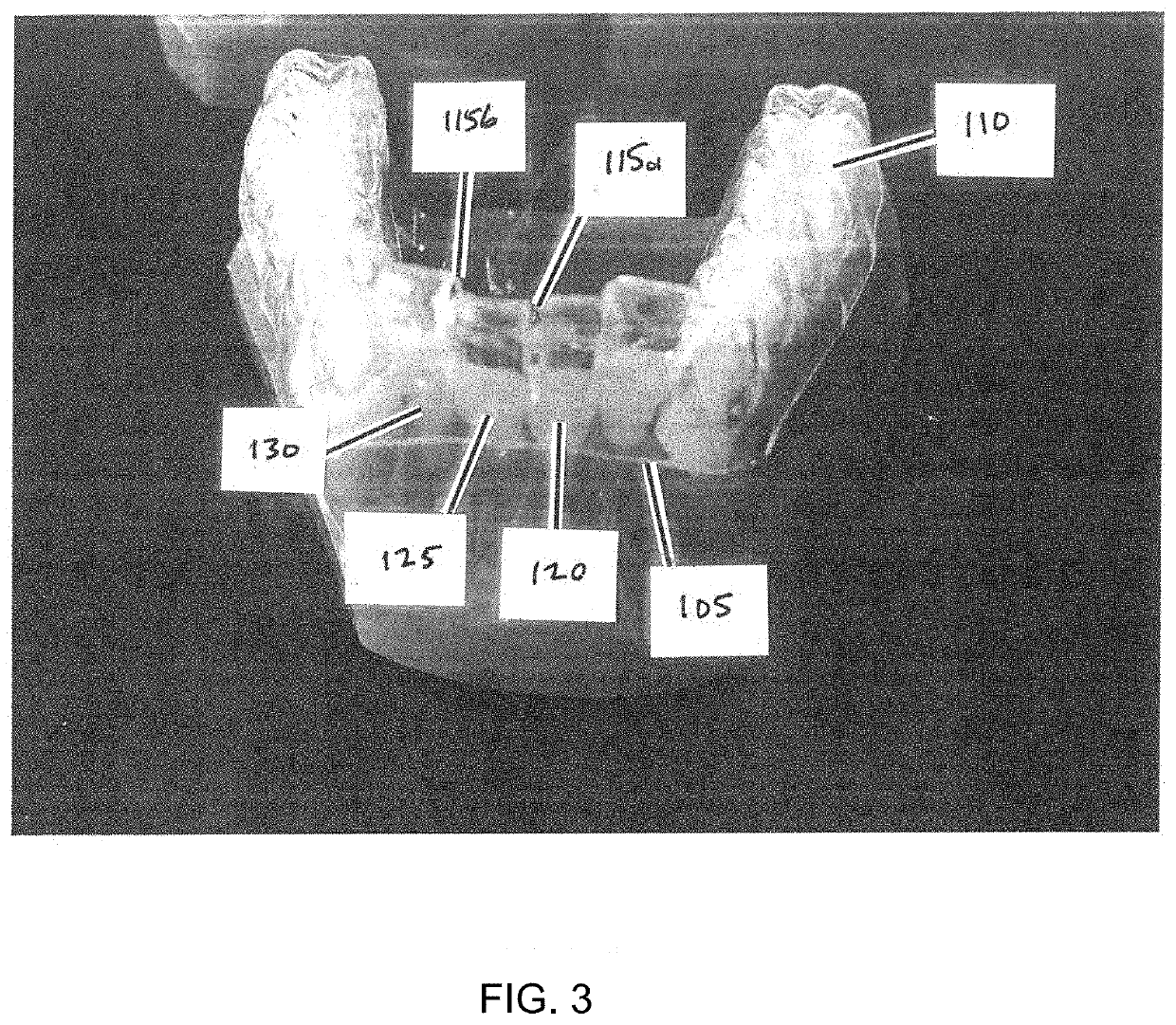 Device and method for interproximal reduction