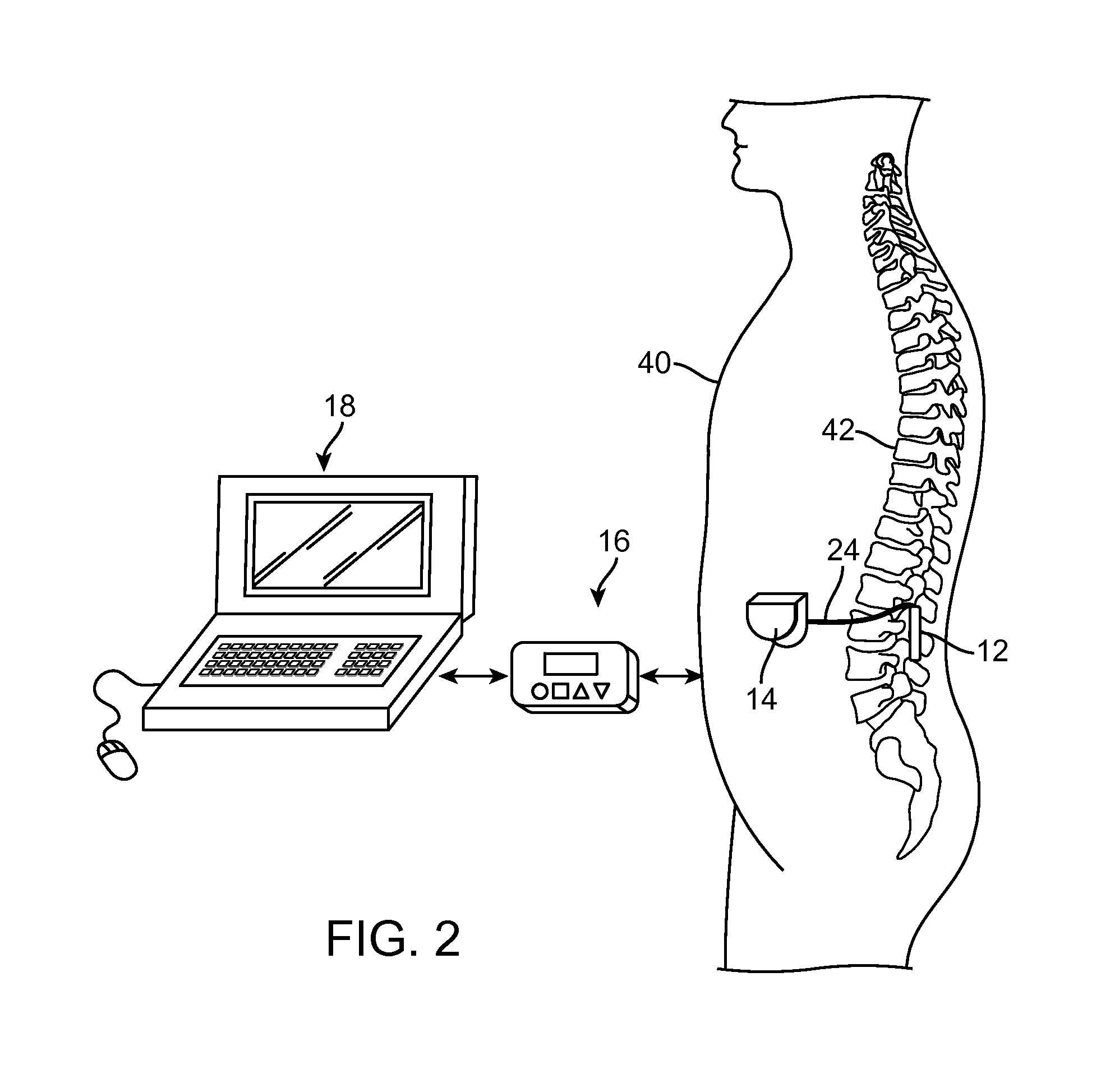 System and method for electrical modulation of the posterior longitudinal ligament