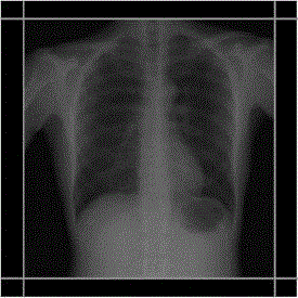 Radiation field control method and device for medical X-ray system