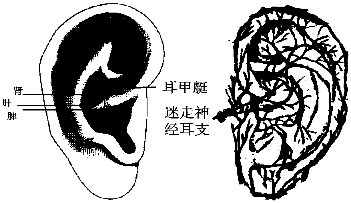 System for treating depression based on 3D printing ear molds