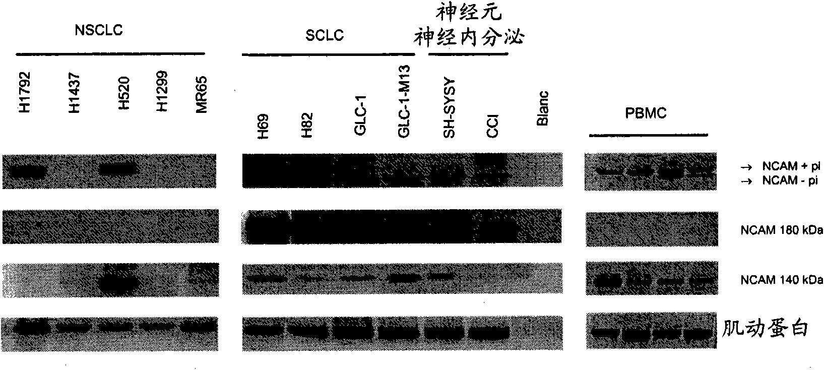 Small cell lung carcinoma biomarker panel