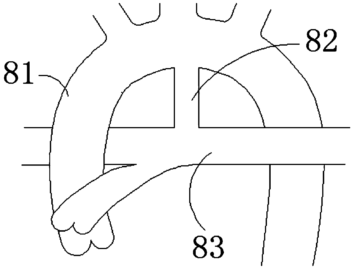 A stent and a stent system