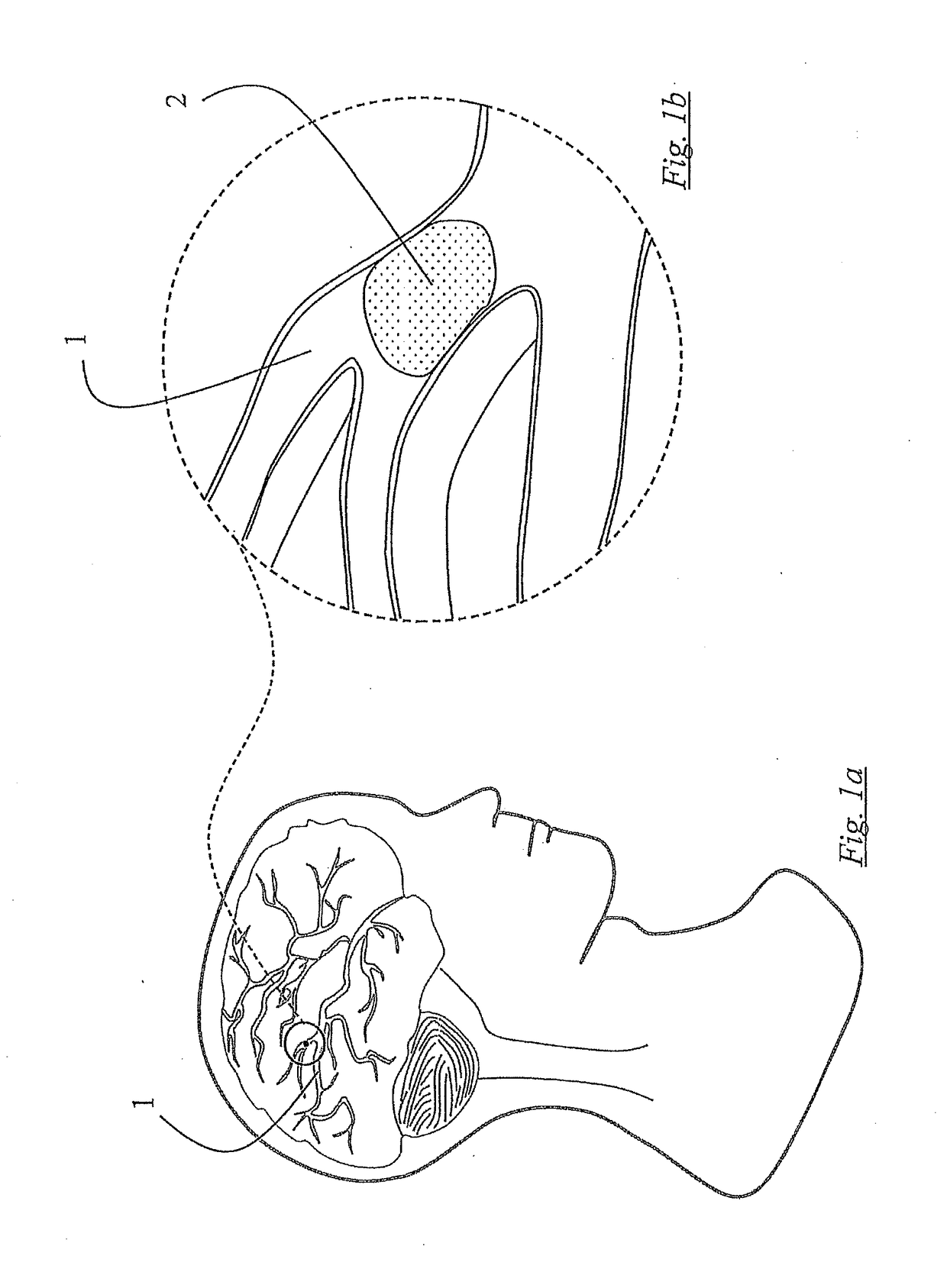 Clot retrieval devices