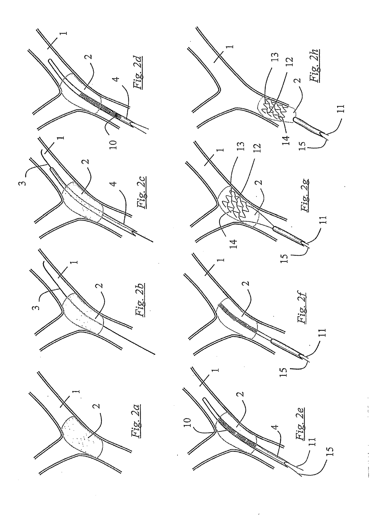 Clot retrieval devices