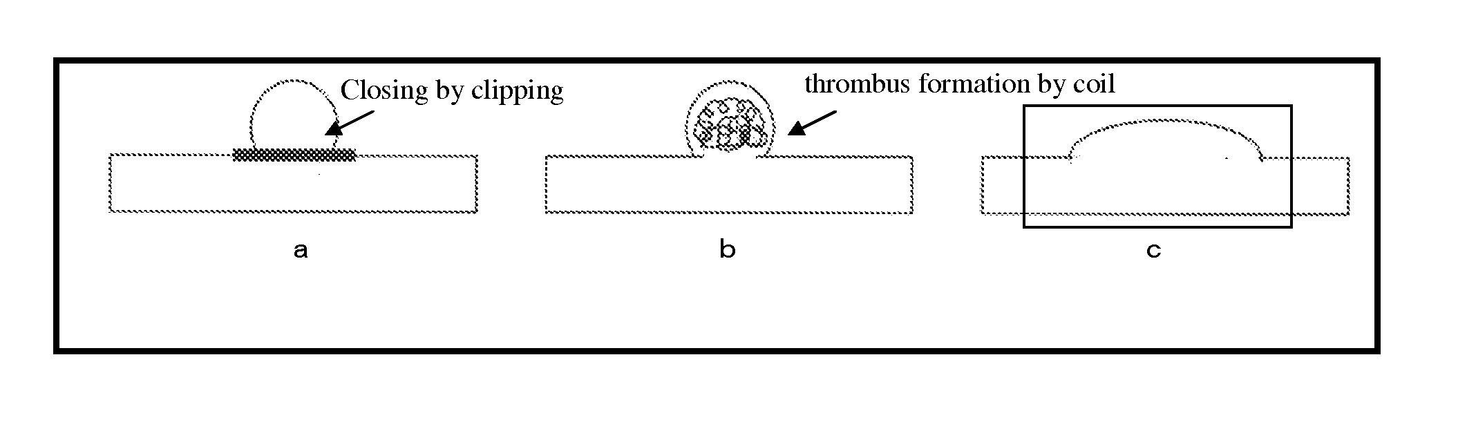 Material for aneurysm curing