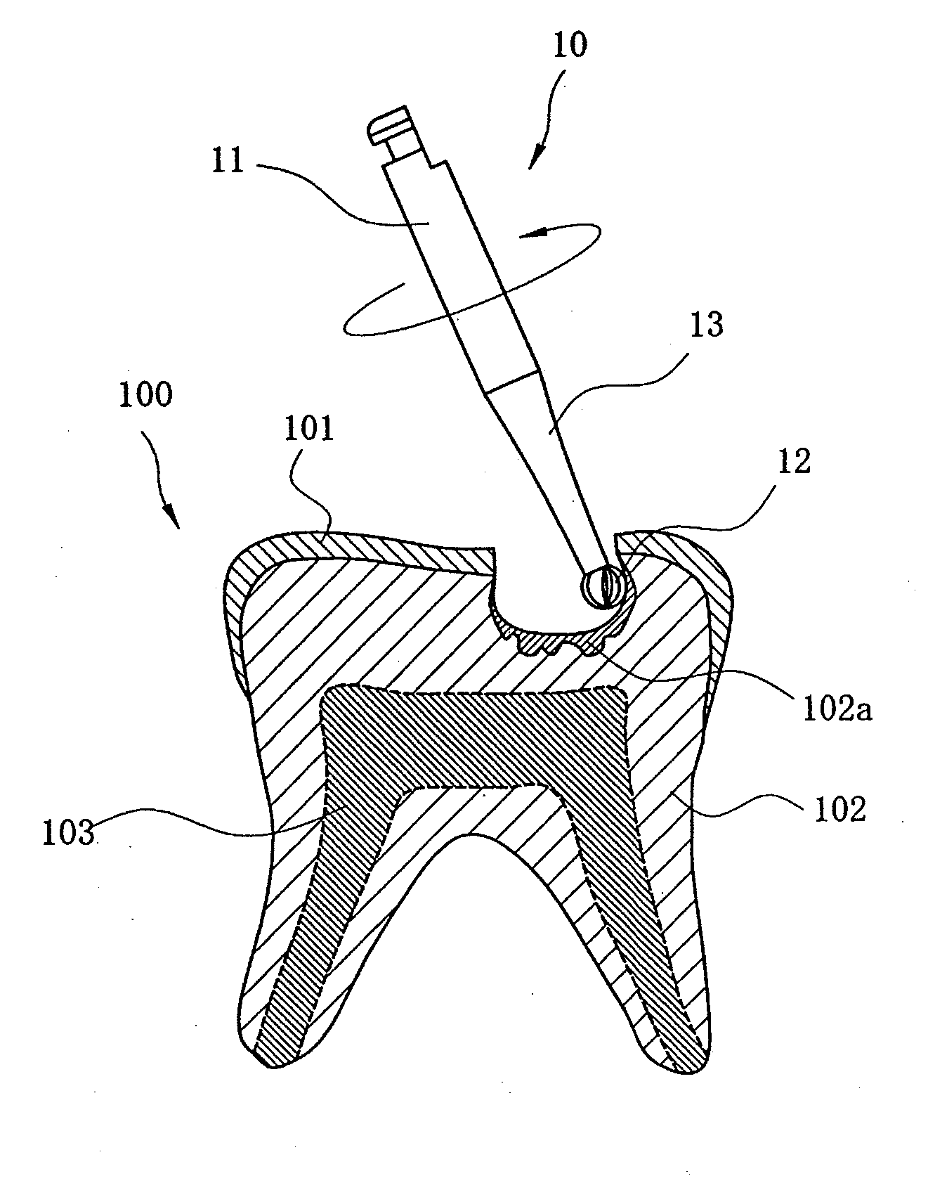 Stainless steel bur