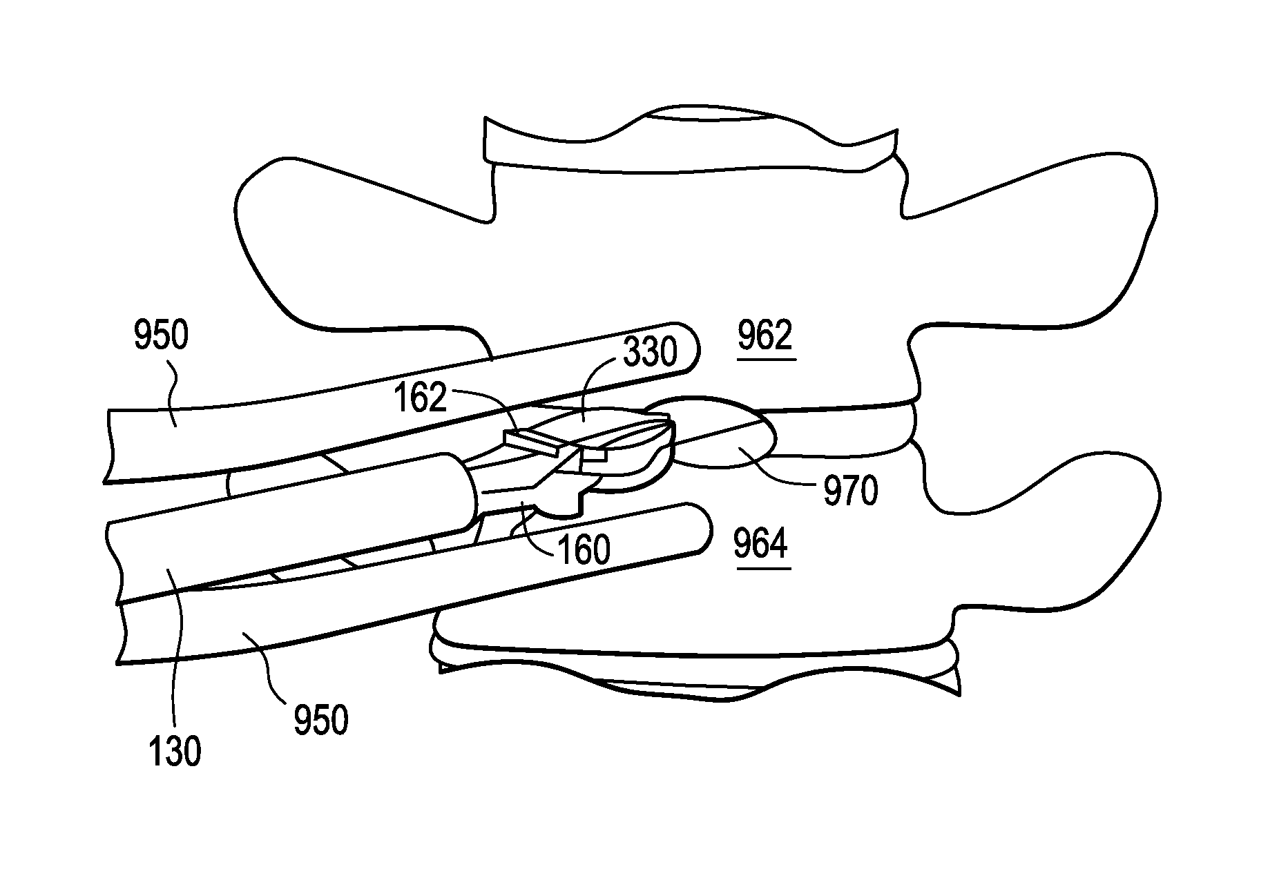 Novel implant inserter having a laterally-extending dovetail engagement feature