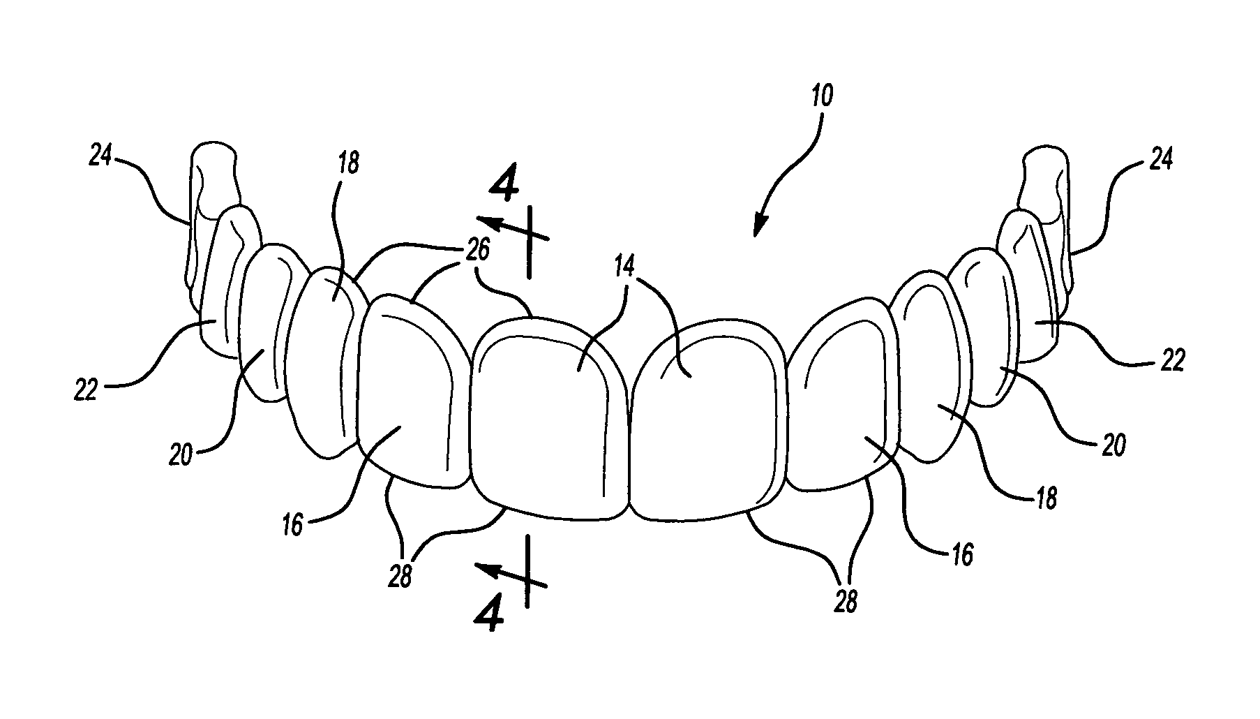 Demonstration dental template and matching temporary overlay