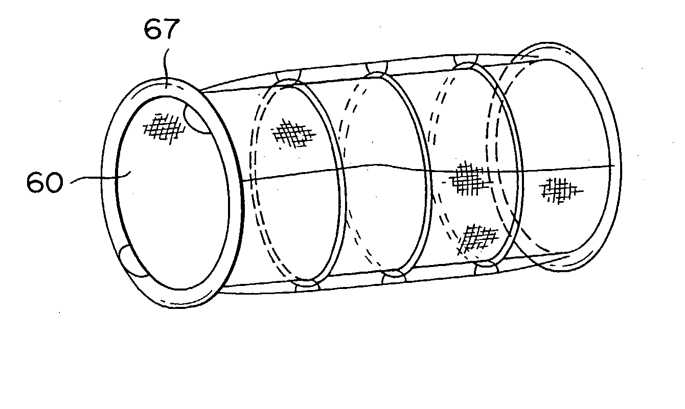 Woven tubing for stent type blood vascular prosthesis and stent type blood vascular prosthesis using the tubing