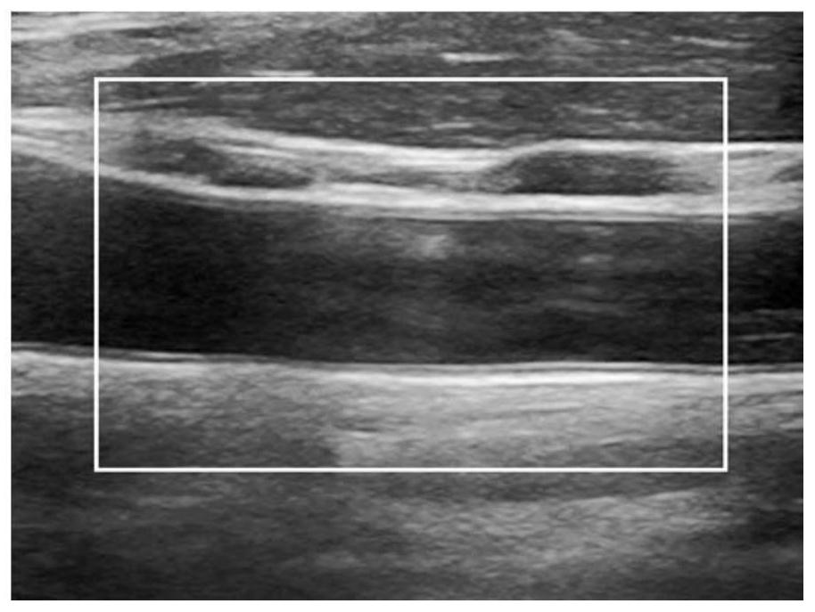 Vascular ultrasound data processing method and device and storage medium