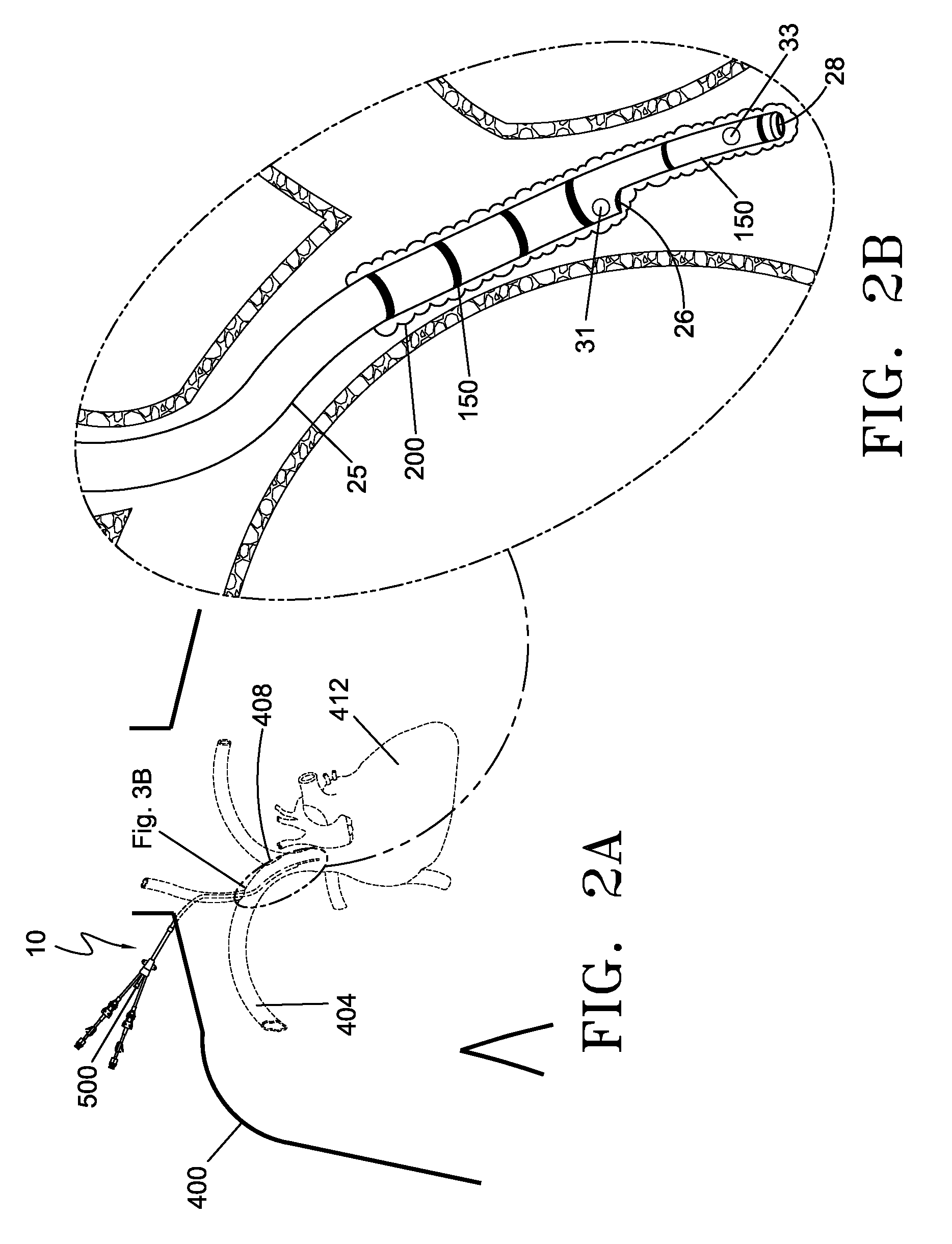 Device and method for the ablation of fibrin sheath formation on a venous catheter