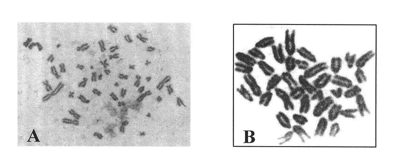 Human pancreatic cancer cell line and its application