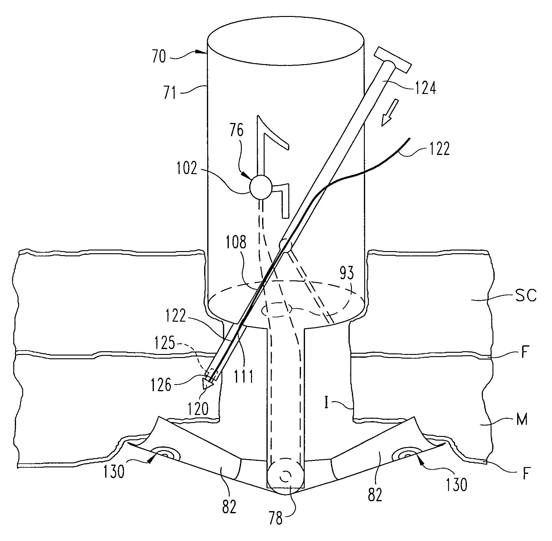 Laparoscopic port site closure tool