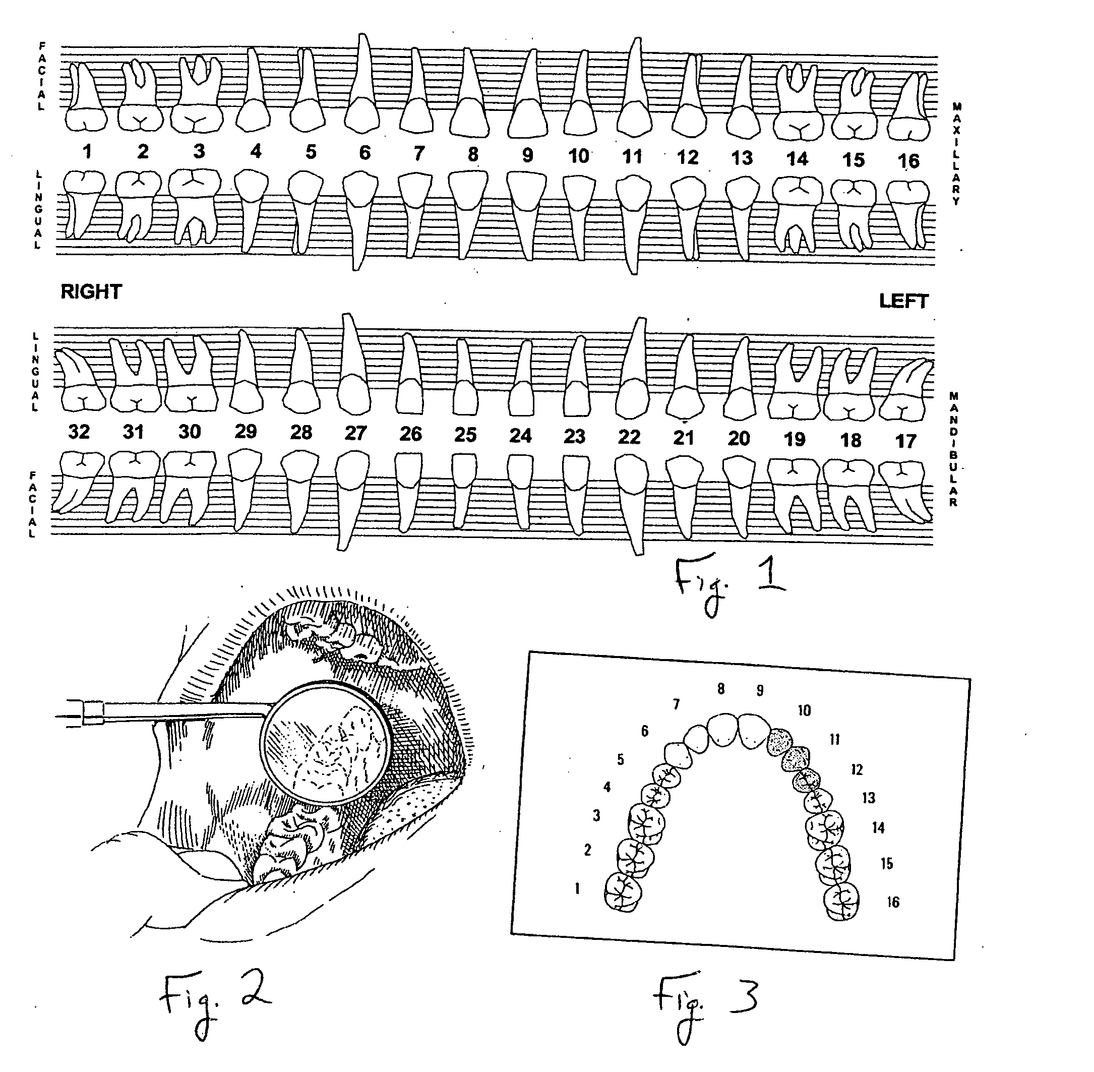 Novel surgical blade for finishing composite fillings on the mesial surface of molars and premolars and method of use