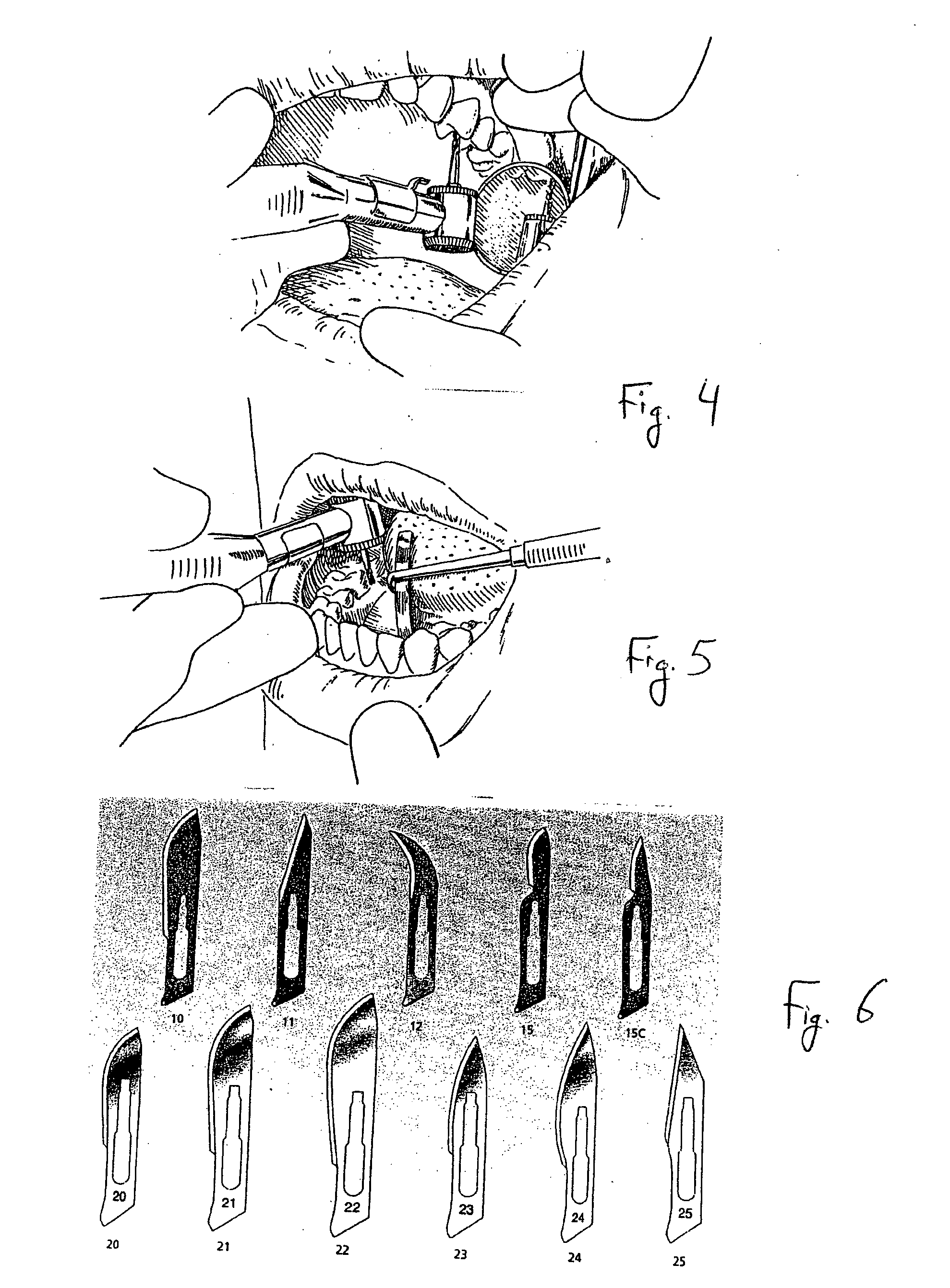 Novel surgical blade for finishing composite fillings on the mesial surface of molars and premolars and method of use