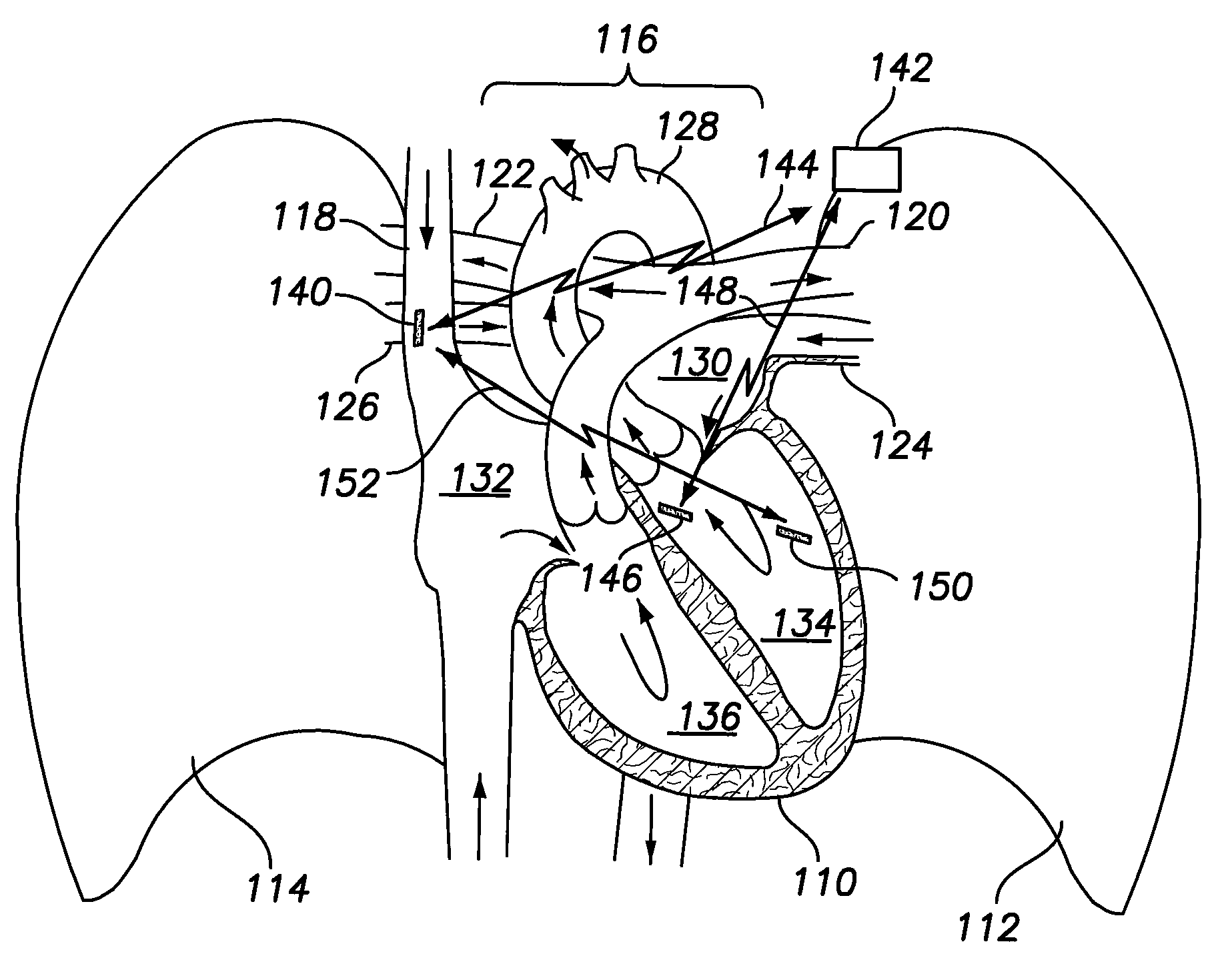 Extra-cardiac impedance based hemodynamic assessment method and system