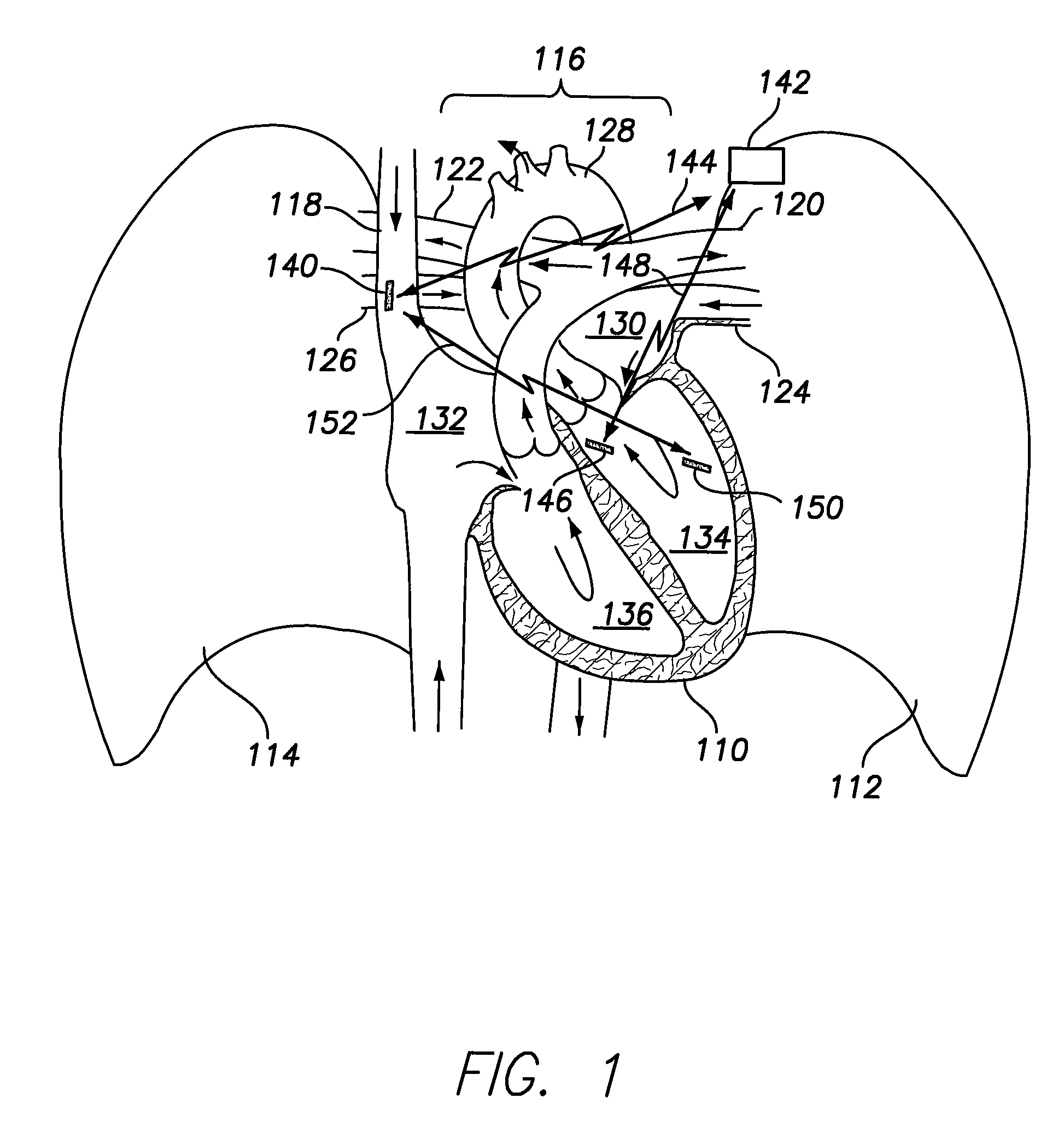 Extra-cardiac impedance based hemodynamic assessment method and system